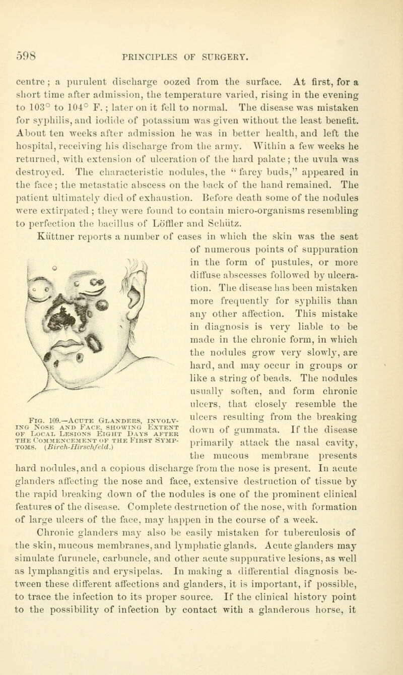 centre ; a purulent discharge oozed from the surface. At first, for a sliort time after admission, the temperature varied, rising in the evening to 103° to 104° F.; later on it fell to normal. The disease was mistaken for syphilis, and iodide of potassium was given without the least benefit. About ten weeks after admission he was in better health, and left the hospital, receiving his discharge from the army. Within a few weeks he returned, with extension of ulceration of the hard palate; the uvula was destroyed. The characteristic nodules, the  fare}' buds, appeared in the face; the metastatic abscess on the back of the hand remained. The patient ultimatelj' died of exhaustion. Before death some of the nodules were extirpated ; the}' were found to contain micro-organisms reseml)ling to perfection the bacillus of Loffler and Schiitz. Kiittner reports a number of cases in which the skin was the seat of numerous points of suppuration in the form of pustules, or more diffuse abscesses followed by ulcera- tion. The disease has been mistaken more frequently for syphilis than any other affection. This mistake in diagnosis is very liable to be made in the chronic form, in which the nodules grow ver}' slowh', are hard, and may occur in groups or like a string of beads. The nodules usually soften, and form chronic ulcers, that closely resemble the FIG. 109.-ACUTE Glanders, involv- leers resulting from the breaking ^^^ t^^rolf^llV'K^J'Tr^l ^lown of gummata. If the disease lo^s:''f^\^^h%l^sckM^^^^^ primarily attack the nasal cavity, the mucous membrane presents hard nodules, and a copious discharge from the nose is present. In acute glanders affecting the nose and face, extensive destruction of tissue by the rapid breaking down of the nodules is one of the prominent clinical features of the disease. Complete destruction of the nose, with formation of large ulcers of the face, may happen in the course of a week. Chronic glanders may also be easil}' mistaken for tuberculosis of the skin, mucous membranes, and hmphatic glands. Acute glanders may simulate furuncle, carbuncle, and other acute suppurative lesions, as well as l^'mphangitis and er3-sipelas. In making a differential diagnosis be- tween these different affections and glanders, it is important, if possible, to trace the infection to its proper source. If the clinical history point to the possibilit}^ of infection by contact with a glanderous horse, it