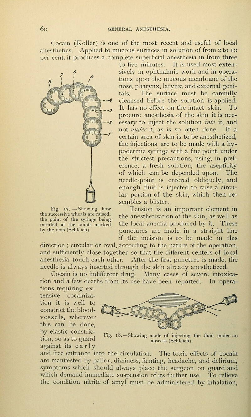 Cocain (KoUer) is one of the most recent and useful of local anesthetics. Applied to mucous surfaces in solution of from 2 to lo per cent, it produces a complete superficial anesthesia in from three to five minutes. It is used most exten- sively in ophthalmic work and in opera- tions upon the mucous membrane of the nose, pharynx, larynx, and external geni- tals. The surface must be carefully cleansed before the solution is applied. It has no effect on the intact skin. To procure anesthesia of the skin it is nec- essary to inject the solution into it, and not under it, as is so often done. If a certain area of skin is to be anesthetized, the injections are to be made with a hy- podermic syringe with a fine point, under the strictest precautions, using, in pref- erence, a fresh solution, the asepticity of which can be depended upon. The needle-point is entered obliquely, and enough fluid is injected to raise a circu- lar portion of the skin, which then re- sembles a blister. Tension is an important element in the anesthetization of the skin, as well as the local anemia produced by it. These punctures are made in a straight line if the incision is to be made in this direction ; circular or oval, according to the nature of the operation, and sufficiently close together so that the different centers of local anesthesia touch each other. After the first puncture is made, the needle is always inserted through the skin already anesthetized. Cocain is no indifferent drug. Many cases of severe intoxica- tion and a few deaths from its use have been reported. In opera- tions requiring ex- tensive cocainiza- tion it is well to constrict the blood- vessels, wherever this can be done, by elastic constric- tion, so as to guard against its early and free entrance into the circulation. The toxic effects of cocain are manifested by pallor, dizziness, fainting, headache, and delirium, symptoms which should always place the surgeon on guard and which demand immediate suspension of its further use. To relieve the condition nitrite of amyl must be administered by inhalation, Fig. 17.—Showing how the successive wheals are raised, the point of the syringe being inserted at the points marked by the dots (Schleich). 18.—Showing mode of injecting the fluid under an abscess (Schleich).