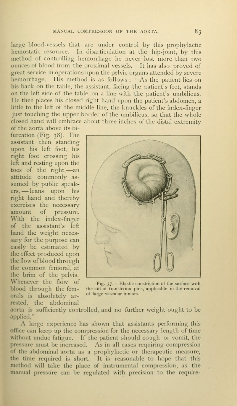 large blood-vessels that are under control by this prophylactic hemostatic resource. In disarticulation at the hip-joint, by this method of controlling hemorrhage he never lost more than two ounces of blood from the proximal vessels. It has also proved of great service in operations upon the pelvic organs attended by severe hemorrhage. His method is as follows : As the patient lies on his back on the table, the assistant, facing the patient's feet, stands on the left side of the table on a line with the patient's umbilicus. He then places his closed right hand upon the patient's abdomen, a litde to the left of the middle line, the knuckles of the index-finger just touching the upper border of the umbiHcus, so that the whole closed hand will embrace about three inches of the distal extremity of the aorta above its bi- furcation (Fig. 38). The assistant then standing upon his left foot, his right foot crossing his left and resting upon the toes of the right,—an attitude commonly as- sumed by public speak- ers.— leans upon his right hand and thereby exercises the necessary amount of pressure. With the index-finger of the assistant's left hand the weight neces- sar\' for the purpose can easily be estimated by the effect produced upon the flow of blood through the common femoral, at the brim of the pelvis. Whenever the flow of blood through the fem- orals is absolutely ar- rested, the abdominal aorta is sufficiently controlled, and no further weight ought to be applied. A large experience has shown that as.sistants performing this office can keep up the compression for the necessary length of time witlujiit undue fatigue. If the patient should cough or vomit, the pressure must be increased. As in all cases requiring compression of the abdominal aorta as a prophylactic or therapeutic measure, the time required is short. It is reasonable to hope that this method will take the place of instrumental compression, as the tnaimal pressure can be regulated with precision to the require- Fig. 37. —Elastic constriction of the surface with the aid of transfixion pins, applicable in the removal of large vascular tumors.