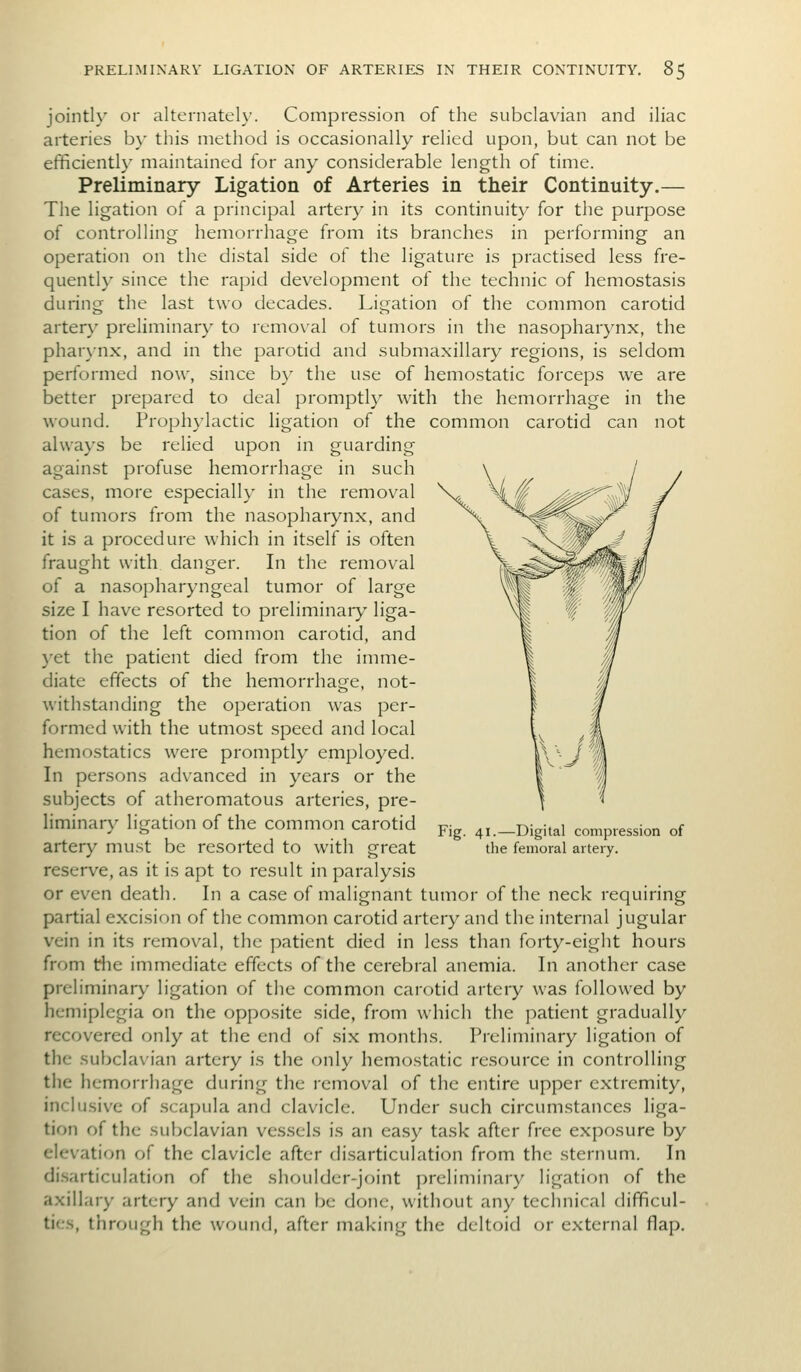 jointly or alternately. Compression of the subclavian and iliac arteries by this method is occasionally relied upon, but can not be efficiently maintained for any considerable length of time. Preliminary Ligation of Arteries in their Continuity.— The ligation of a principal artery in its continuity for the purpose of controlling hemorrhage from its branches in performing an operation on the distal side of the ligature is practised less fre- quently since the rapid development of the technic of hemostasis during the last two decades. Ligation of the common carotid artery preliminary to removal of tumors in the nasopharynx, the pharynx, and in the parotid and submaxillary regions, is seldom performed now, since by the use of hemostatic forceps we are better prepared to deal promptl}^ with the hemorrhage in the wound. Prophylactic ligation of the common carotid can not always be relied upon in guarding against profuse hemorrhage in such cases, more especially in the removal of tumors from the nasopharynx, and it is a procedure which in itself is often fraught with danger. In the removal of a nasopharyngeal tumor of large size I have resorted to preliminary liga- tion of the left common carotid, and yet the patient died from the imme- diate effects of the hemorrhage, not- withstanding the operation was per- formed with the utmost speed and local hemostatics were promptly employed. In persons advanced in years or the subjects of atheromatous arteries, pre- liminary ligation of the common carotid artery must be resorted to with great reserve, as it is apt to result in paralysis or even death. In a case of malignant tumor of the neck requiring partial excision of the common carotid artery and the internal jugular vein in its removal, the patient died in less than forty-eight hours from the immediate effects of the cerebral anemia. In another case preliminary ligation of the common carotid artery was followed by hemiplegia on the opposite side, from which the patient gradually recovered only at the end of six months. Preliminary ligation of the subclavian artery is the only hemostatic resource in controlling tiie hemorrhage during the removal of the entire upper extremity, inclusive of scapula and clavicle. Under such circumstances liga- tion of the subclavian vessels is an easy task after free exposure by elevation of the clavicle after disarticulation from the sternum. In di.sarticulation of the shoulder-joint i)rcliminary ligation of the axillary artery and vein can be done, without any technical difficul- ties, through the wound, after making the deltoid or external flap. Fig. 41.—Digital compression of the femoral artery.