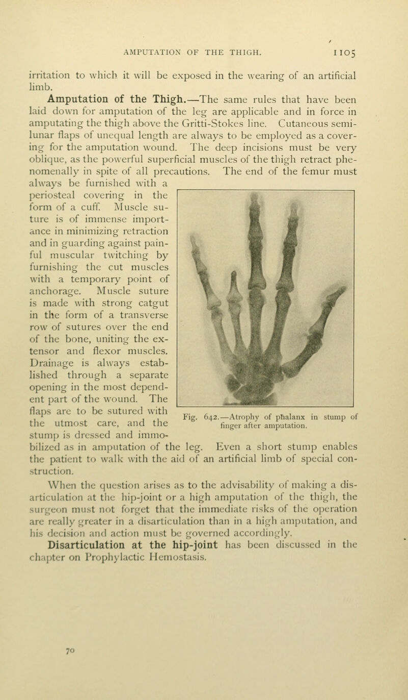 irritation to which it will be exposed in the wearing of an artificial limb. Amputation of the Thigh.—The same rules that have been laid down for amputation of the leg are applicable and in force in amputating the thigh above the Gritti-Stokes line. Cutaneous semi- lunar flaps ot unequal length are always to be employed as a cover- ing for the amputation wound. The deep incisions must be very oblique, as the powerful superficial muscles of the thigh retract phe- nomenally in spite of all precautions. The end of the femur must always be furnished with a periosteal covering in the form of a cuff! Muscle su- ture is of immense import- ance in minimizing retraction and in guarding against pain- ful muscular twitching by furnishing the cut muscles with a temporary point of anchorage. Muscle suture is made with strong catgut in the form of a transverse row of sutures over the end of the bone, uniting the ex- tensor and flexor muscles. Drainage is always estab- lished through a separate opening in the most depend- ent part of the wound. The flaps are to be sutured with the utmost care, and the stump is dressed and immo- bilized as in amputation of the leg. Even a short stump enables the patient to walk with the aid of an artificial limb of special con- .struction. When the question arises as to the advisability of making a dis- articulation at tiic hip-joint or a high amputation of the thigh, the surgeon must not forget that the immediate risks of the operation are really greater in a disarticulation than in a high amiJiitation, and his decision and action must be governed accordingly. Disarticulation at the hip-joint has been discussed in the chapter on I'roph) lactic Ilemostasis. Fig. 642.—Atrophy of phalanx in stump of finger after amputation. 70