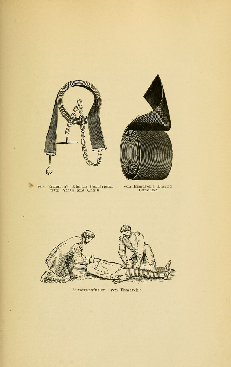 ^ von Esmarch's Elastic Constrictor von Esmareh's Elastic with Strap and Chain. Bandage. Autotransfusion—von Esmarch's.