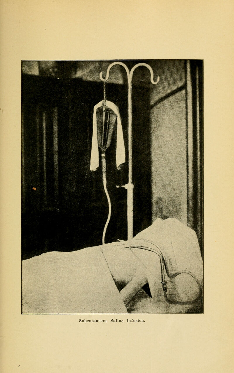 Subcutaneous SaliHe Infusion.