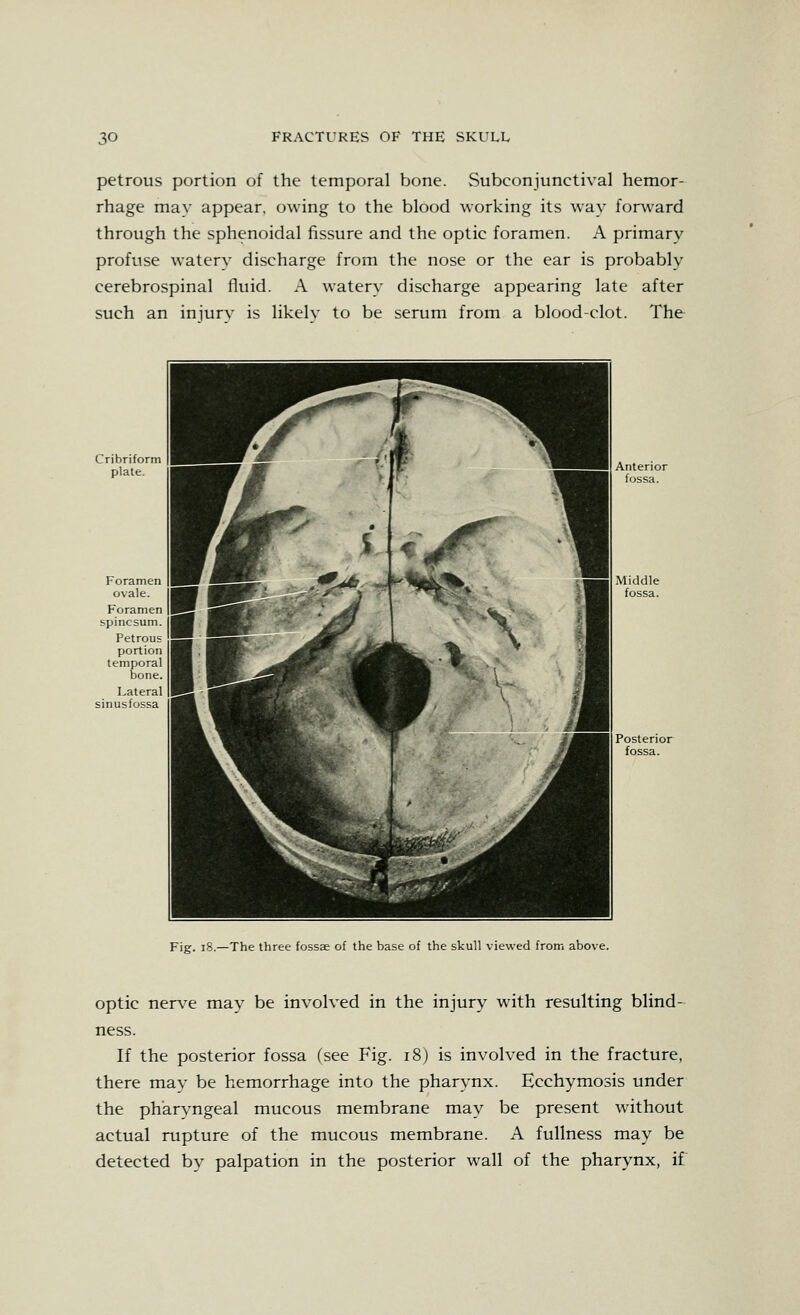 petrous portion of the temporal bone. Subconjunctival hemor- rhage may appear, owing to the blood working its way forAvard through the sphenoidal fissure and the optic foramen. A primary profuse watery discharge from the nose or the ear is probably cerebrospinal fluid. A watery discharge appearing late after such an injury is likely to be serum from a blood-clot. The Foramen ovale. Foramen spincsum. Petrous portion temporal bone. Lateral sinusfossa Fig. i8.—The three fossae of the base of the skull viewed from above. optic nerve may be involved in the injury with resulting blind- ness. If the posterior fossa (see Fig. i8) is involved in the fracture, there may be hemorrhage into the pharynx. Ecchymosis under the pharyngeal mucous membrane may be present without actual rupture of the mucous membrane. A fullness may be detected by palpation in the posterior wall of the pharynx, if