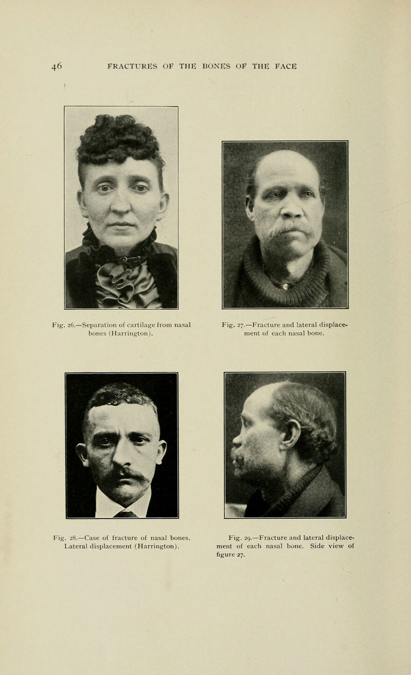 Fig. 26.—Separation of cartilage from nasal Fig. 27.—Fracture and lateral displace- bones (Harrington). ment of each nasal bone. Fig. 28.—Case of fracture of nasal bones. Lateral displacement (Harrington). Fig. 29.—Fracture and lateral displace- ment of each nasal bone. Side view of figure 27.