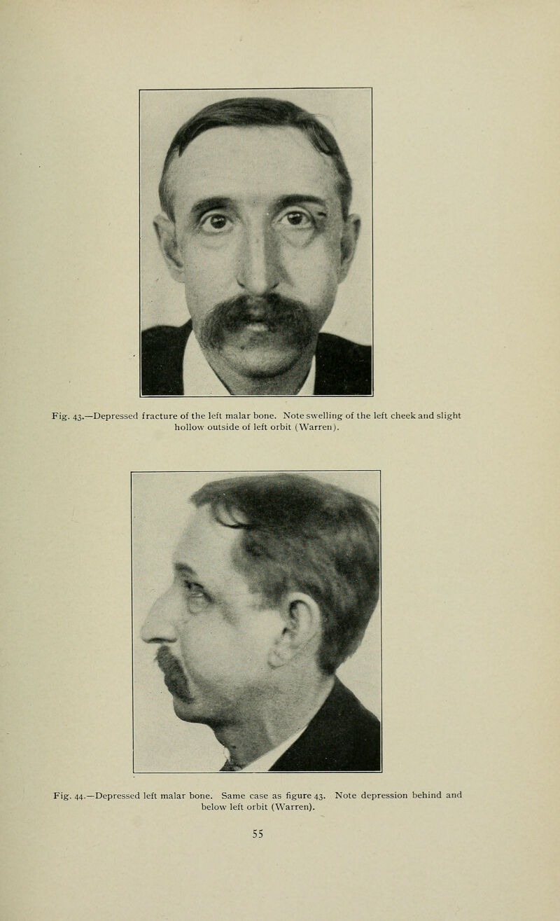 Fig. 43.—Depressed fracture of the left malar bone. Note swelling of the left cheek and slight hollow outside of left orbit (Warren). Fig. 44.—Depressed left malar bone. Same case as figure 43. Note depression behind and below left orbit (Warren).