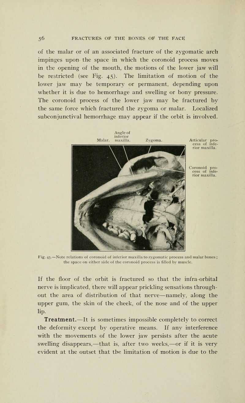 of the malar or of an associated fracture of the zygomatic arch impinges upon the space in which the coronoid process moves in the opening of the mouth, the motions of the lower jaw will be restricted (see Fig. 45). The limitation of motion of the lower jaw may be temporary or permanent, depending upon whether it is due to hemorrhage and swelling or bony pressure. The coronoid process of the lower jaw may be fractured by the same force which fractured the zygoma or malar. Localized subconjunctival hemorrhage may appear if the orbit is involved. Ang^le of inferior Malar. maxilla. Zyj^oma. Articular pro- cess of infe- rior maxilla. Coronoid pro- cess of infe- rior maxilla. Fig. 45.—Note relations of coronoid of inferior ma.xilla to zygomatic process and malar bones ; the space on either side of the coronoid process is filled by muscle. If the floor of the orbit is fractured so that the infra-orbital nerve is implicated, there will appear prickling sensations through- out the area of distribution of that nerve—namely, along the upper gum, the skin of the cheek, of the nose and of the upper lip. Treatment.—It is sometimes impossible completely to correct the deformity except by operative means. If any interference with the movements of the lower jaw persists after the acute swelling disappears,—that is, after two weeks,—or if it is very evident at the outset that the limitation of motion is due to the