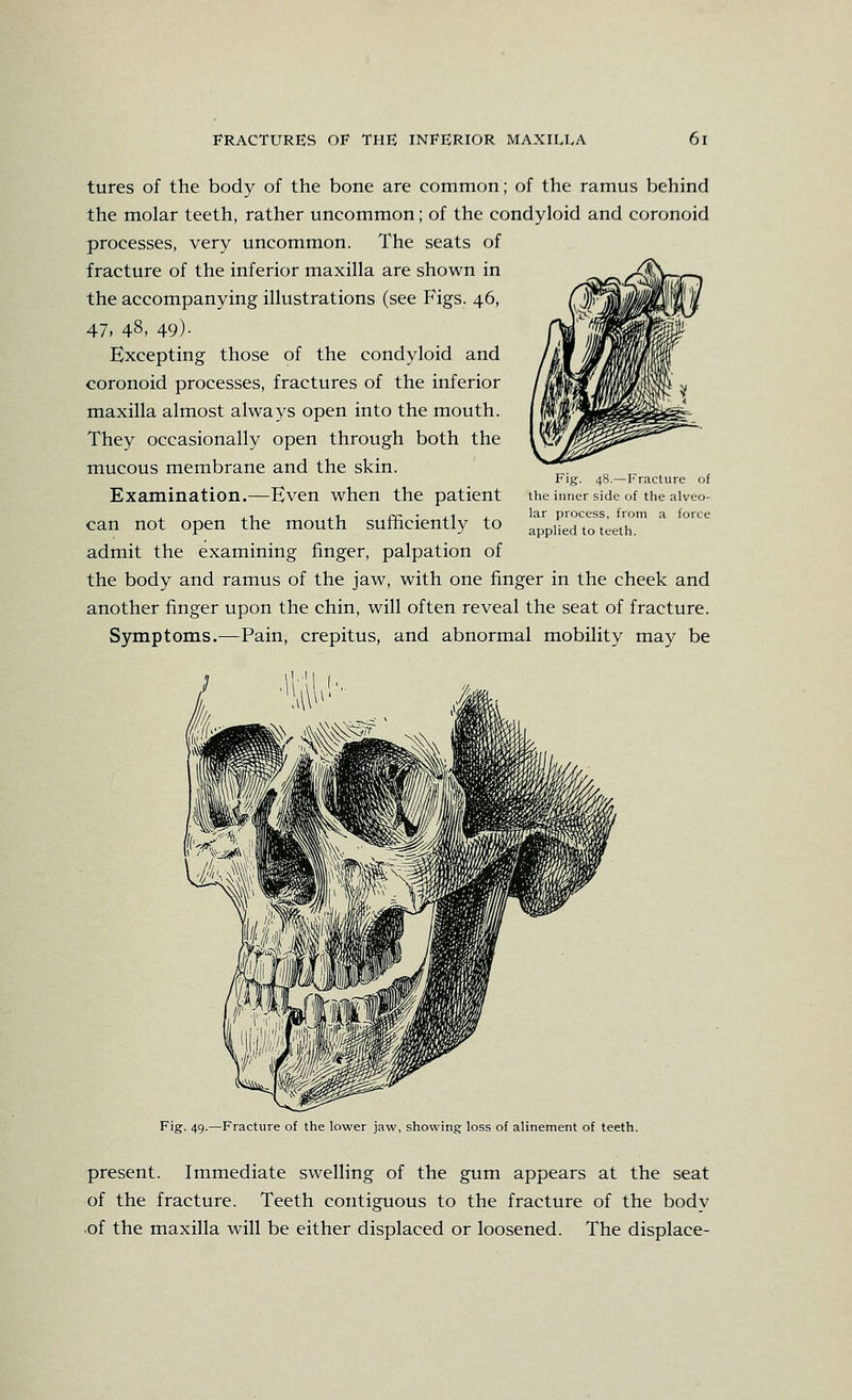 tures of the body of the bone are common; of the ramus behind the molar teeth, rather uncommon; of the condyloid and coronoid processes, very uncommon. The seats of fracture of the inferior maxilla are shown in the accompanying illustrations (see Figs. 46, 47, 48, 49)- Excepting those of the condyloid and coronoid processes, fractures of the inferior maxilla almost always open into the mouth. They occasionally open through both the mucous membrane and the skin. Examination.—Even when the patient can not open the mouth sufficiently to admit the examining finger, palpation of the body and ramus of the jaw, with one finger in the cheek and another finger upon the chin, will often reveal the seat of fracture. Symptoms.—Pain, crepitus, and abnormal mobility may be Fig. 48.—Fracture of the inner side of the alveo- lar process, from a force applied to teeth. Fig. 4.9.—Fracture of the lower jaw, showing loss of alinement of teeth. present. Immediate swelling of the gum appears at the seat of the fracture. Teeth contiguous to the fracture of the body of the maxilla will be either displaced or loosened. The displace-