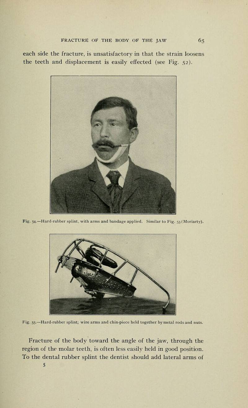 each side the fracture, is unsatisfactory in that the strain loosens the teeth and displacement is easily effected (see Fig. 52). Fig. 54.—Hard-rubber splint, with arms and bandage applied. Similar to Fig. 53 (Moriarty). A ^fe- '\ ^V sd^-^il wL \ ^ Fig- 55-—Hard-rubber splint; wire arms and chin-piece held together by metal rods and nuts. Fracture of the body toward the angle of the jaw, through the region of the molar teeth, is often less easily held in good position. To the dental rubber splint the dentist should add lateral arms of 5