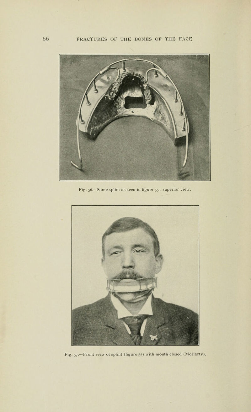 Fig. 56.—Same splint as seen in figure 55 ; superior view. Fig. 57.—Front view of splint (figure 55) with mouth closed (Moriarty).