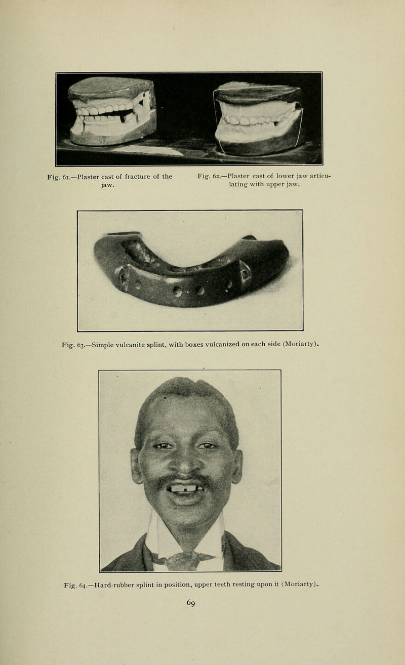 Fig. 6i.—Plaster cast of fracture of the jaw. Fig. 62.—Plaster cast of lower jaw articu- lating with upper jaw. Fig. 63.—Simple vulcanite splint, with boxes vulcanized on each side (Moriarty). Fig. 64.—Hard-rubber splint in position, upper teeth resting upon it (Moriarty).