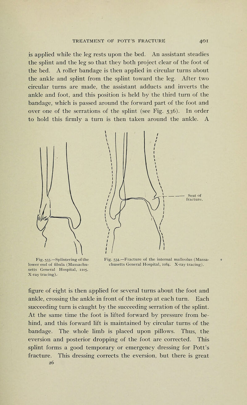 is applied while the leg rests upon the bed. An assistant steadies the splint and the leg so that they both project clear of the foot of the bed. A roller bandage is then applied in circular turns about the ankle and splint from the splint toward the leg. After two circular turns are made, the assistant adducts and inverts the ankle and foot, and this position is held by the third turn of the bandage, which is passed around the forward part of the foot and over one of the serrations of the splint (see Fig. 536). In order to hold this firmly a turn is then taken around the ankle. A Fig. 533.—Splintering of the lower end of fibula (Massachu- setts General Hospital, 1105. X-ray tracing).- Seat of fracture. Fig. 534.—Fracture of the internal malleolus (Massa- chusetts General Hospital, 1084. X-raj' tracing). figure of eight is then applied for several turns about the foot and ankle, crossing the ankle in front of the instep at each turn. Each succeeding turn is ca,ught by the succeeding serration of the splint. At the same time the foot is lifted forward by pressure from be- hind, and this forward lift is maintained by circular turns of the bandage. The whole limb is placed upon pillows. Thus, the eversion and posterior dropping of the foot are corrected. This splint forms a good temporary or emergency dressing for Pott's fracture. This dressing corrects the eversion, but there is great 26