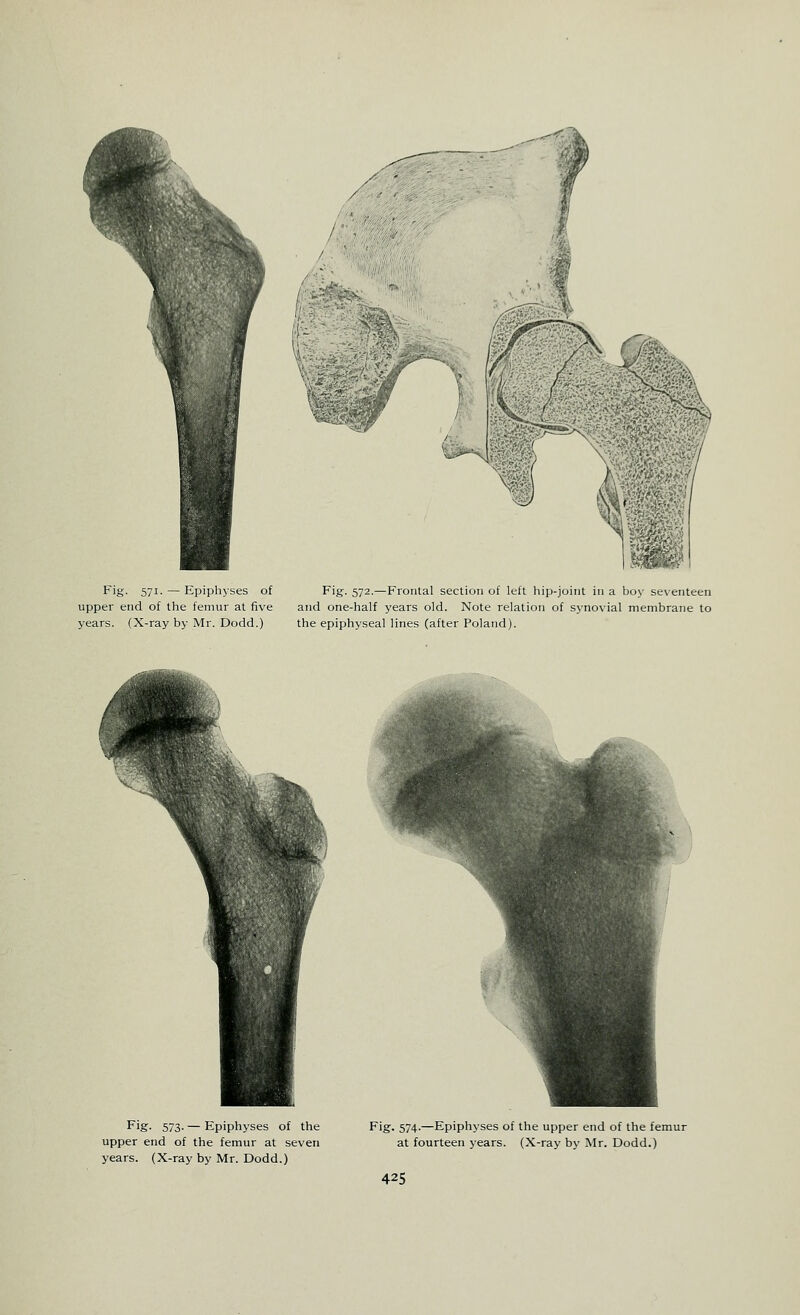 Fig. 571. — Epiphyses of upper end of the femur at five years. (X-ray by Mr. Dodd.) Fig-. 572.—Frontal section of left hip-joint in a boy seventeen and one-half years old. Note relation of synovial membrane to the epiphyseal lines (after Poland). Fig- 573- — Epiphyses of the upper end of the femur at seven years. (X-ray by Mr. Dodd.) F'g- 574-—Epiphyses of the upper end of the femur at fourteen years. (X-ray by Mr. Dodd.)