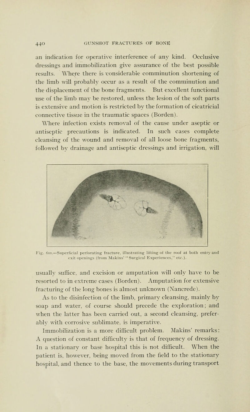 an indication for operative interference of any kind. Occlusive dressings and immobilization give assurance of the best possible results. Where there is ronsiderable comminution shortening of the limb will probably occur as a result of the comminution and the displacement of the bone fragments. But excellent functional use of the limb mav be restored, unless the lesion of the soft parts is extensive and motion is restricted by the formation of cicatricial connective tissue in the traumatic spaces (Borden). Where infection exists removal of the cause under aseptic or antiseptic precautions is indicated. In such cases complete cleansing of the wound and removal of all loose bone fragments, followed by drainage and antiseptic dressings and irrigation, will Fig. 600.—Superficial perforating fracture, illustrating lifting of the roof at both entry and exit openings (from Makins' Surgical Experiences, etc.). usually suffice, and excision or amputation will only have to be resorted to in extreme cases (Borden). Amputation for extensive fracturing of the long bones is almost unknown (Xancrede). As to the disinfection of the limb, primary cleansing, mainly by soap and water, of course should precede the exploration; and when the latter has been carried out, a second cleansing, prefer- ably with corrosive sublimate, is imperative. Immobilization is a more difficult problem. Makins' remarks: A question of constant difficulty is that of frequency of dressing. In a stationary or base hospital this is not difficult. When the patient is, however, being moved from the field to the stationary hospital, and thence to the base, the movements during transport