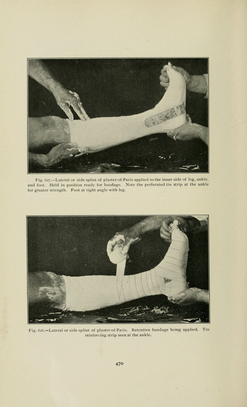 Fig. 627.—Lateral or side splint of plaster-of-Paris applied to the inner side of leg, ankle, and foot. Held in position ready for bandage. Note the perforated tin strip at the ankle for greater strength. Foot at right angle with leg. Fig. 628.—Lateral or side splint of plaster-of-Paris. Retentive bandage being applied. Tin reinforcing strip seen at the ankle.