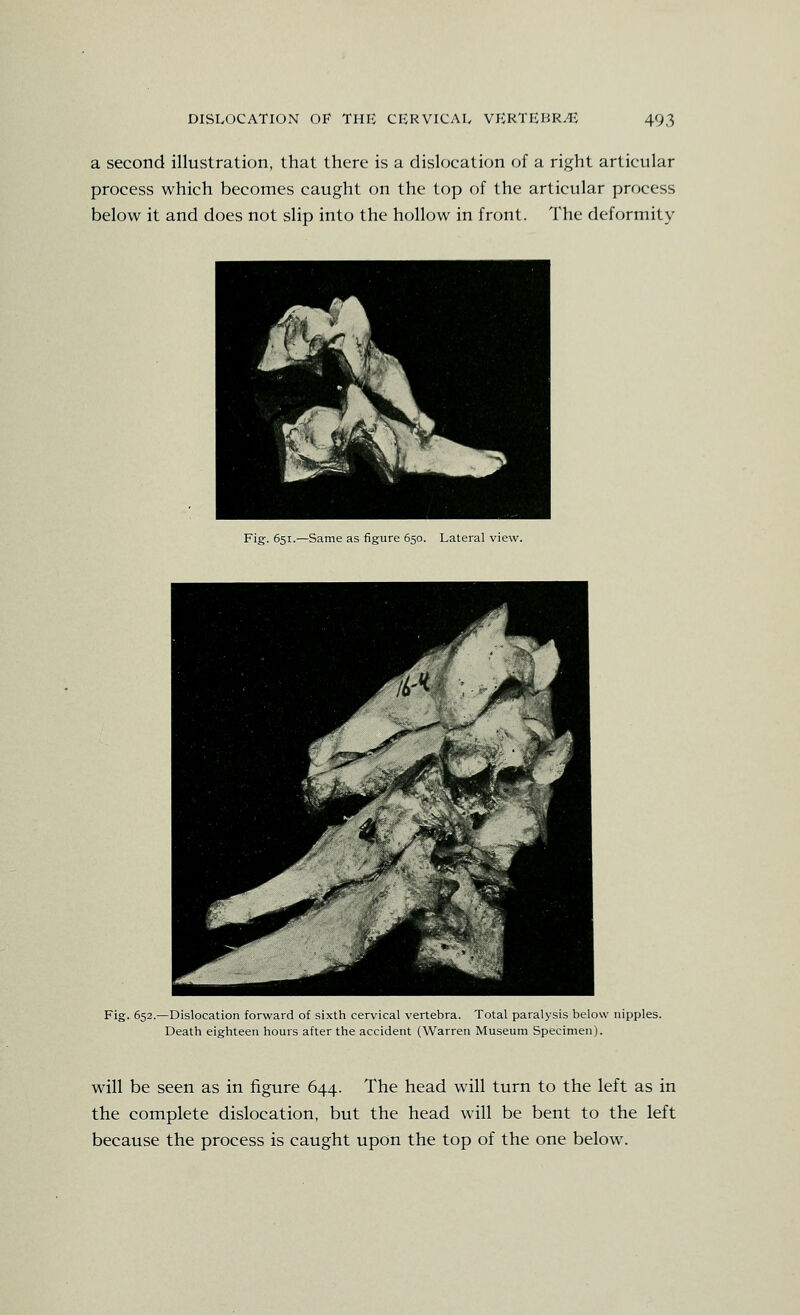 a second illustration, that there is a dislocation of a right articular process which becomes caught on the top of the articular prrjcess below it and does not slip into the hollow in front. The deformity Fig. 651.—Same as figure 650. Lateral view. Fig. 652.—Dislocation forward of sixth cervical vertebra. Total paralysis below nipples. Death eighteen hours after the accident (Warren Museum Specimen). will be seen as in figure 644. The head will turn to the left as in the complete dislocation, but the head will be bent to the left because the process is caught upon the top of the one below.