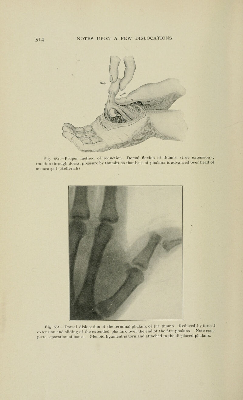 ^^t^tUi>M-'Mli>& Fig. 68i.—Proper method of reduction. Dorsal flexion of thumbs (true extension) ; traction through dorsal pressure by thumbs so that base of phalanx is advanced over head of metacarpal (Helferich) Fig. 6S2.—Dorsal dislocation of the terminal phalanx of the thumb. Reduced by forced extension and sliding of the extended phalanx over the end of the first phalanx. Note com- plete separation of bones. Glenoid ligament is torn and attached to the displaced phalanx.