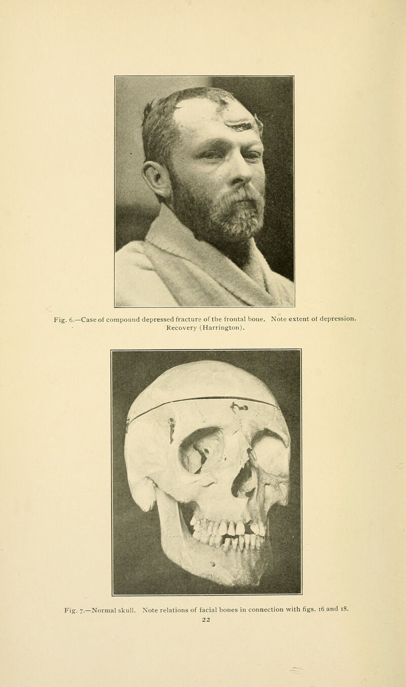 Fig. 6.—Case of compound depressed fracture of the frontal bone. Note extent of depression. Recovery (Harrington). Fig. 7.—Normal skull. Note relations of facial bones in connection witii figs. 16 and 18.