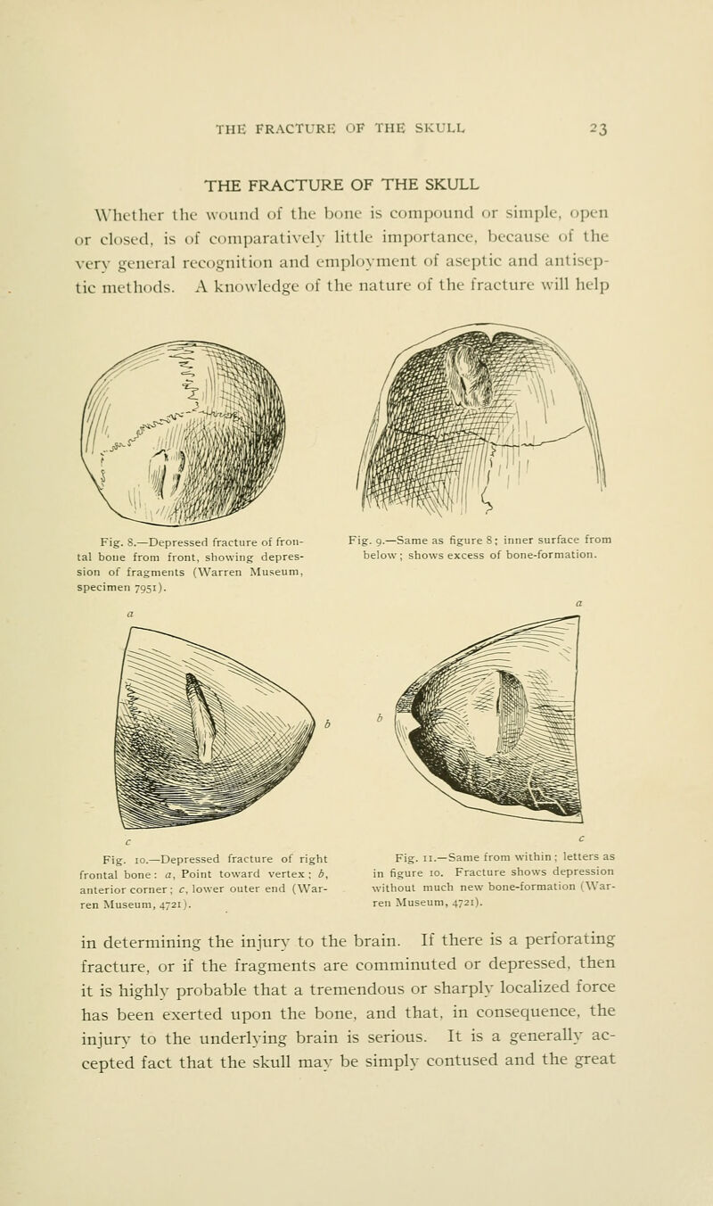 THE FRACTURE OF THE SKULL WIkiIkt ihv wouiul of lliL' bone is compound or simple, open or closed, is of comparatively little importance, because of the xerx general recognition and employment of aseptic and antisep- tic methods. A knowledge of the nature of the fracture will heli) Fig. 8.—Depressed fracture of fron- tal bone from front, showing depres- sion of fragments (Warren Museum, specimen 7951). Fig. 9.—Same as figure 8; inner surface from below; shows excess of bone-formation. Fig. 10.—Depressed fracture of right frontal bone : a, Point toward vertex ; b, anterior corner; c, lower outer end (War- ren Museum, 4721). Fig. II.—Same from within ; letters as in figure 10. Fracture shows depression without much new bone-formation (War- ren Museum, 4721). in determining the injurs- to the brain. If there is a perforating fracture, or if the fragments are comminuted or depressed, then it is highly probable that a tremendous or sharply localized force has been exerted upon the bone, and that, in consequence, the injury to the underlying brain is serious. It is a generally ac- cepted fact that the skull may be simply contused and the great