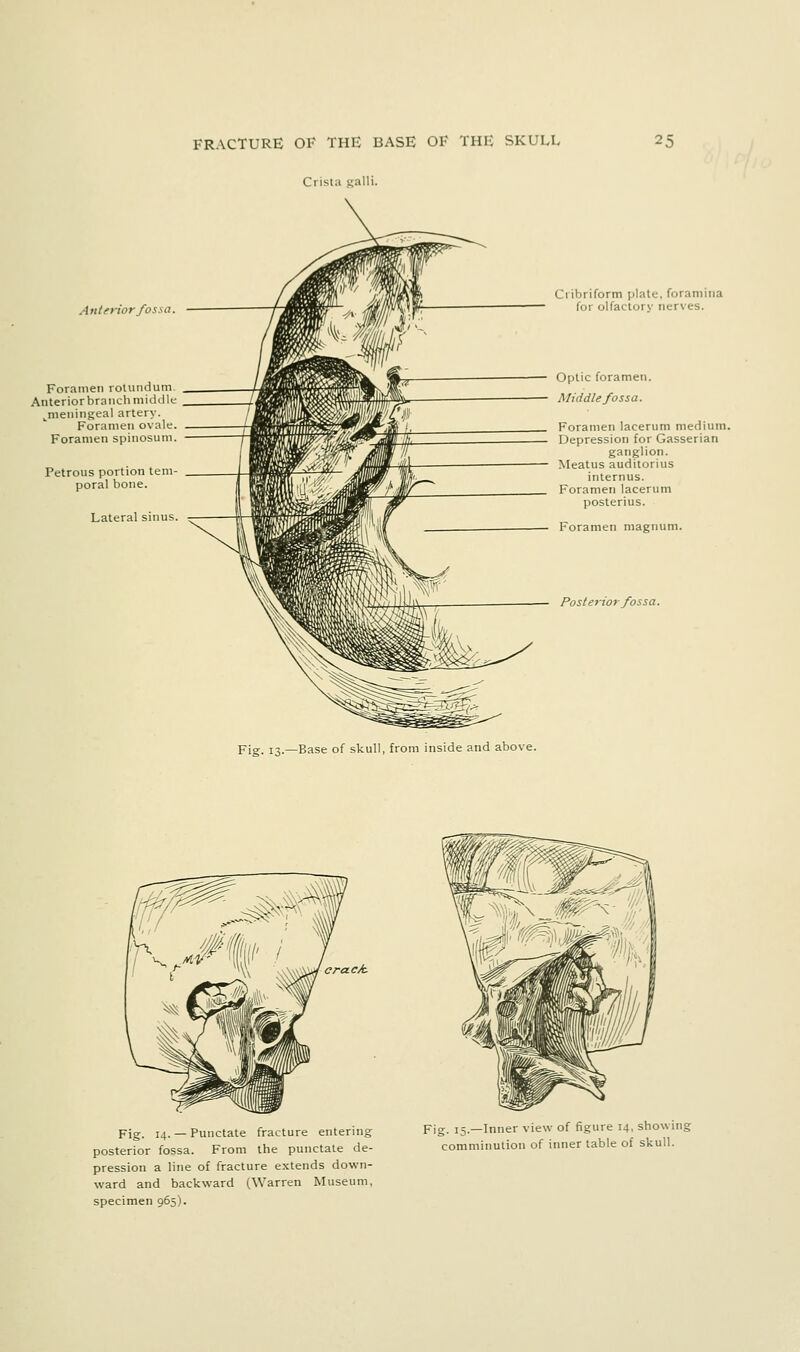 FRACTURE OF THE BASE OF THE SKULL Crista sialli. 25 AntfHor fossa. Foramen rotundum Anterior branch niidiUc ^meningeal artery. Foramen ovale. Foramen spinosum. Petrous portion tem- poral bone. Lateral sinus Cribriform plate, foramina for olfactory nerves. Optic foramen. Middle fossa. Foramen lacerum medium. Depression for Gasserian ganglion. — Meatus auditorius internus. Foramen lacerum posterius. Foramen magnum. Posterior fossa. V\%. i^.—Base of skull, from inside and above. crack. Fig. 14. — Punctate fracture entering posterior fossa. From the punctate de- pression a line of fracture extends down- ward and backward (Warren Museum, specimen 965). Fig. 15.—Inner view of figure 14, showing comminution of inner table of skull.