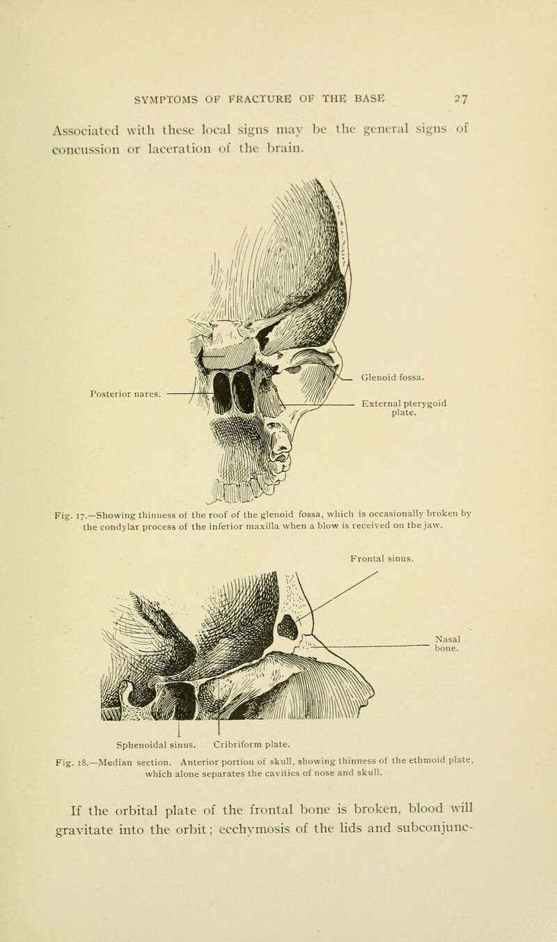 Associated with these local signs may be the general signs of concussion or laceration of the brain. Posterior nares. Glenoid fossa. External pterygoid plate. Fig. 17.—Showing thinness of the roof of the glenoid fossa, which is occasionally broken by the condylar process of the inferior maxilla when a blow is received on the jaw. Frontal sinus. Sphenoidal sinus. Cribriform plate. Fig. iS.—Median section. Anterior portion of skull, showing thinness of the ethmoid plate, which alone separates the cavities of nose and skull. If the orbital plate of the frontal bone is broken, blood Avill gravitate into the orbit; ecchymosis of the lids and subconjunc-