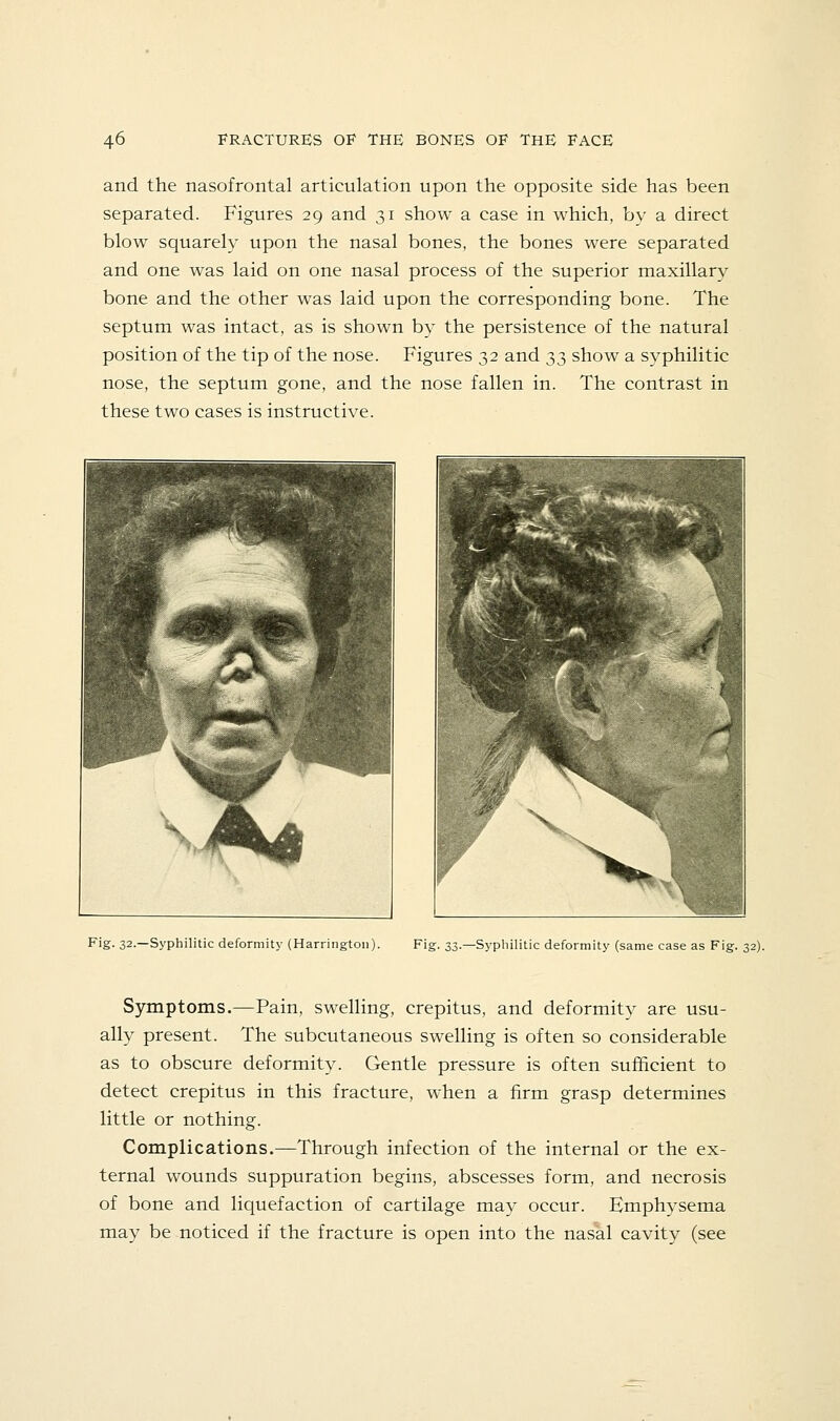 and the nasofrontal articulation upon the opposite side has been separated. Figures 29 and 31 show a case in which, bv a direct blow squarely upon the nasal bones, the bones were separated and one was laid on one nasal process of the superior maxillary bone and the other was laid upon the corresponding bone. The septum was intact, as is shown by the persistence of the natural position of the tip of the nose. Figures 32 and 33 show a syphilitic nose, the septum gone, and the nose fallen in. The contrast in these two cases is instructive. Fig. 32.—Syphilitic deformity (Harrington). Fig. 33.—Syphilitic deformity (same case as Fig. 32). Symptoms.—Pain, swelling, crepitus, and deformity are usu- ally present. The subcutaneous swelling is often so considerable as to obscure deformity. Gentle pressure is often sufficient to detect crepitus in this fracture, when a firm grasp determines little or nothing. Complications.—Through infection of the internal or the ex- ternal wounds suppuration begins, abscesses form, and necrosis of bone and liquefaction of cartilage may occur. Emphysema may be noticed if the fracture is open into the nasal cavity (see