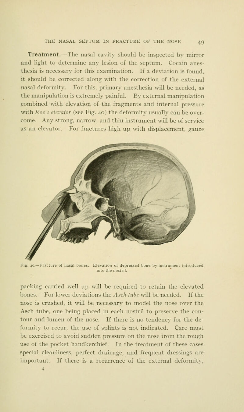 Treatment.—The nasal cavity should be inspected bv mirror and light to determine any lesion of the septum. Cocain anes- thesia is necessary for this examination. If a deviation is found, it should be corrected along with the correction of the external nasal deformity. For this, primary' anesthesia will be needed, as the manipulation is extremely painful. By external manipulation combined with elevation of the fragments and internal pressure with Roe's elevator (see Fig. 40) the deformity usually can be over- come. Any strong, narrow, and thin instrument will be of service as an elevator. For fractures high up with displacement, gauze Fig. 40.—Fracture of nasal bones. Elevation of depressed bone by instrument introduced into the nostril. packing carried w'ell up will be required to retain the elevated bones. For lower deviations the Asch tube will be needed. If the nose is crushed, it will be necessar\^ to model the nose over the Asch tube, one being placed in each nostril to preserve the con- tour and lumen of the nose. If there is no tendency for the de- formity to recur, the use of splints is not indicated. Care must be exercised to avoid sudden pressure on the nose from the rough use of the pocket handkerchief. In the treatment of these cases special cleanliness, perfect drainage, and frequent dressings are important. If there is a recurrence of the external deformity, 4