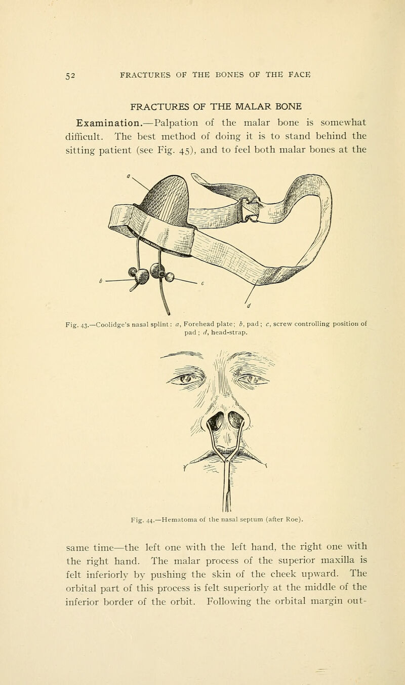 FRACTURES OF THE MALAR BONE Examination,—Palpation of the malar bone is somewhat difHcult. The best method of doing it is to stand behind the sitting patient (see Fig. 45), and to feel both malar bones at the Fig. 43.—Coolidge's nasal splint: a, Forehead plate; b, pad; c, screw controlling position of pad ; li, head-strap. 7* Fig. 44.—Hematoma of the nasal septum (after Roe). same time—the left one with the left hand, the right one with the right hand. The malar process of the superior maxilla is felt inferiorly by pushing the skin of the cheek upward. The orbital part of this process is felt superiorly at the middle of the inferior border of the orbit. Following the orbital margin out-