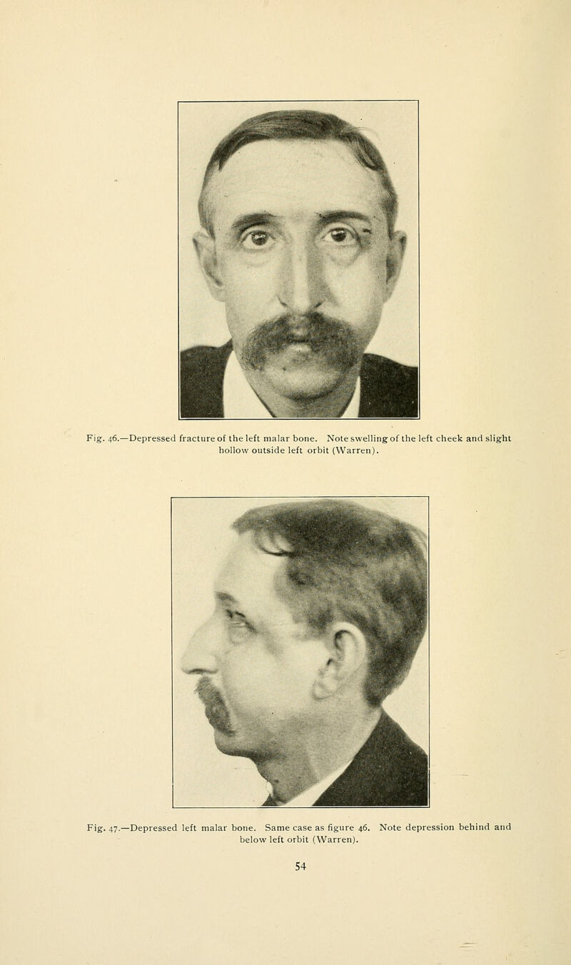 Fig. 46.—Depressed fracture of the left malar bone. Note swelling of the left cheek and slight hollow outside left orbit (Warren). Fig. 47.—Depressed left malar bone. Same case as figure 46. Note depression behind and below left orbit (Warren).