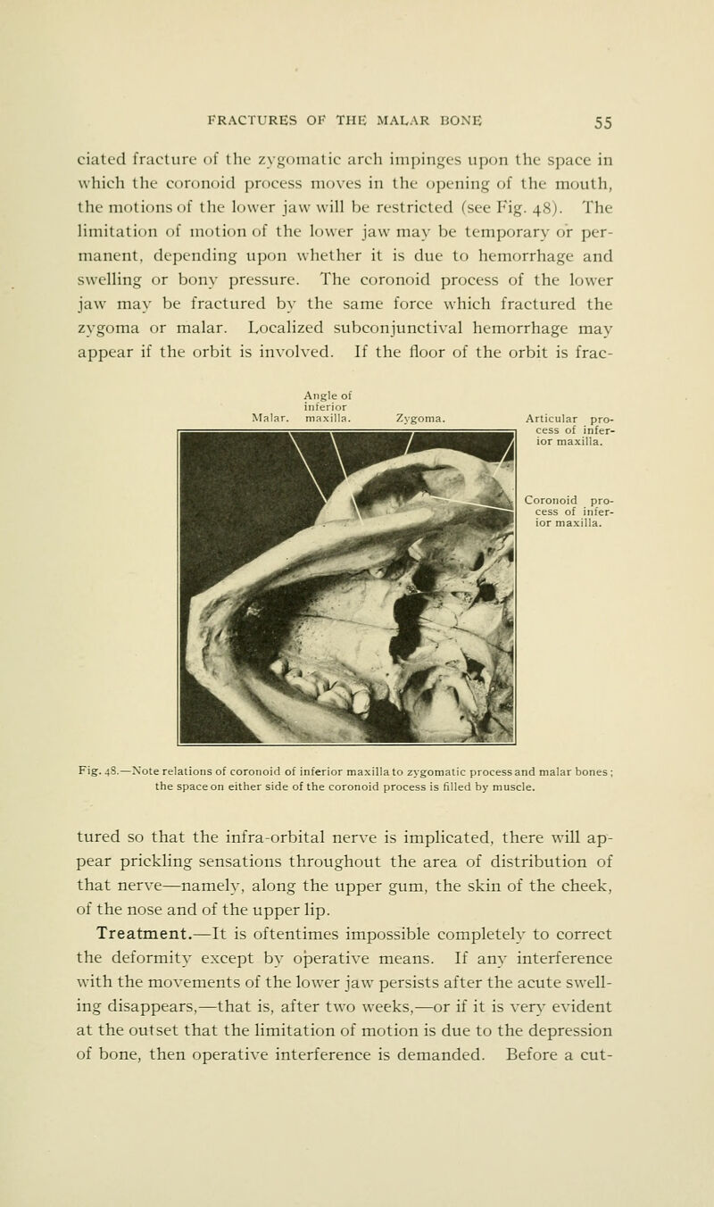 ciatcd fracture of the zygomatic arch impinges upon the space in whicli the coronoid process nio\-es in the opening of the mouth, the motions of the lower jaw will be restricted (see Fig. 48). The limitation of motion of the lower jaw may be temporary or per- manent, depending upon whether it is due to hemorrhage and swelling or bony pressure. The coronoid process of the lower jaw may be fractured by the same force which fractured the zygoma or malar. Localized subconjunctival hemorrhage may appear if the orbit is involved. If the floor of the orbit is frac- Articular pro- cess of infer- ior maxilla. Coronoid pro- cess of infer- ior maxilla. Fig. 48.—Note relations of coronoid of inferior maxilla to zygomatic process and malar bones; the space on either side of the coronoid process is filled by muscle. tured so that the infra-orbital nerv^e is implicated, there will ap- pear prickling sensations throughout the area of distribution of that nerve—namely, along the upper gum, the skin of the cheek, of the nose and of the upper lip. Treatment.—It is oftentimes impossible completely to correct the deformity except by operative means. If any interference with the movements of the lower jaw persists after the acute swell- ing disappears,—that is, after two weeks,—or if it is very evident at the outset that the limitation of motion is due to the depression of bone, then operative interference is demanded. Before a cut-