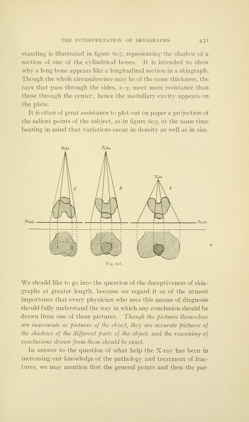 standinj^ is illustrated in figure 607, representing the shadow of a section of one of the cylindrical bones. It is intended to show why a long bone appears like a longitudinal section in a skiagraph. Though the whole circumference may be of the same thickness, the rays that pass through the sides, x-y, meet more resistance than those through the center; hence the medullary cavity appears on the plate. It is often of great assistance to plot out on paper a projection of the salient points of the subject, as in figure 603, at the same time bearing in mind that variations occur in densitv as well as in size. TVaii PUt< Fig. 60S. We should like to go into the question of the deceptiveness of skia- graphs at greater length, because we regard it as of the utmost importance that ever}- physician who uses this means of diagnosis should fully understand the wa}' in which any conclusion should be drawn from one of these pictures. Though the pictures themselves are inaccurate as pictures of the object, they are accurate pictures of the shadows of the different parts of the object, and the reasoning of conclusions drawn from them should be exact. In answer to the question of what help the X-ray has been in increasing our knowledge of the pathology- and treatment of frac- tures, we may mention first the general points and then the par-