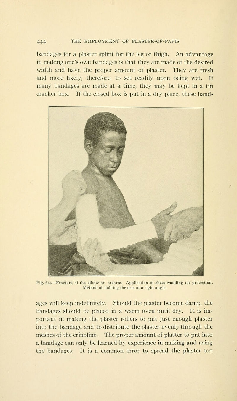 bandages for a plaster splint for the leg or thigh. An advantage in making one's own bandages is that they are made of the desired width and have the proper amount of plaster. They are fresh and more likely, therefore, to set readily upon being wet. If many bandages are made at a time, they may be kept in a tin cracker box. If the closed box is put in a dry place, these band- Fig. 614.—Fracture of the elbow or orearm. Application ot sheet wadding tor protection. Method of holding the arm at a right angle. ages will keep indefinitely. Should the plaster become damp, the bandages should be placed in a warm oven until dry. It is im- portant in making the plaster rollers to put just enough plaster into the bandage and to distribute the plaster evenly through the meshes of the crinoline. The proper amount of plaster to put into a bandage can only be learned by experience in making and using the bandages. It is a common error to spread the plaster too
