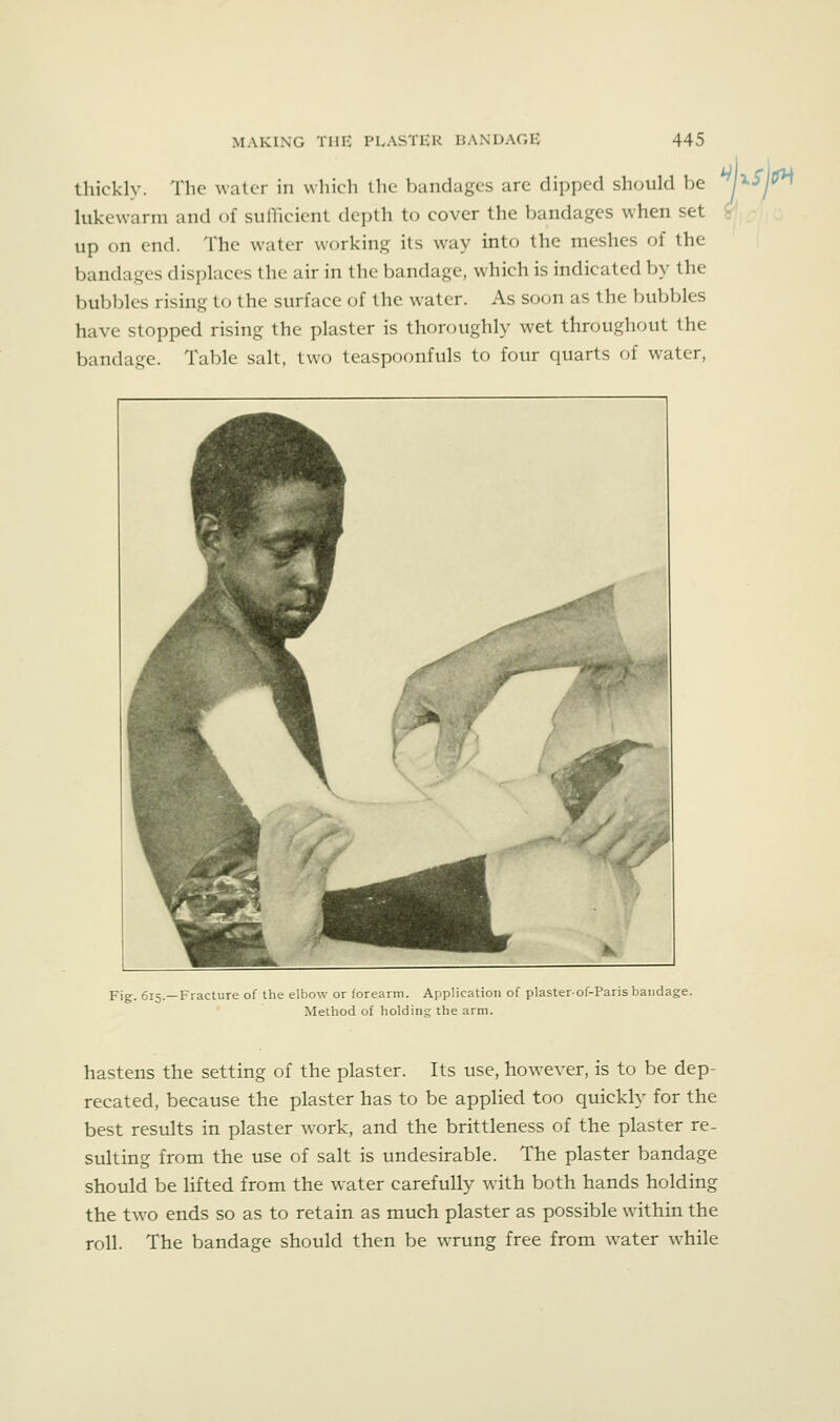 thicklv. The water in wliicli the bandages are dipped should be r^Sj^ lukewarm and of sufficient depth to cover the bandages when set > up on end. The water working its way into the meshes of the bandages displaces the air in the bandage, which is indicated by the bubbles rising to the surface of the water. As soon as the bubbles have stopped rising the plaster is thoroughly wet throughout the bandage. Table salt, two teaspoonfuls to four quarts of water, Fig. 615.—Fracture of the elbow or forearm. Application of plasterof-Paris bandage. Method of holding the arm. hastens the setting of the plaster. Its use, how^ever, is to be dep- recated, because the plaster has to be applied too quickly for the best results in plaster work, and the brittleness of the plaster re- sulting from the use of salt is undesirable. The plaster bandage should be lifted from the w-ater carefully with both hands holding the two ends so as to retain as much plaster as possible within the roll. The bandage should then be wrung free from water while