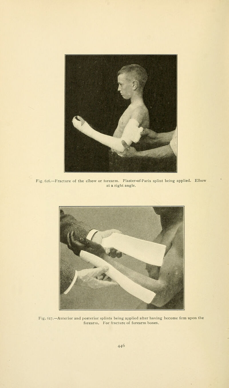 Fig. 616.—Fracture of the elbow or forearm. Plaster-of-Paris splint being applied. Elbow at a right angle. Fig. 617.—Anterior and posterior splints being applied after having become firm upon the forearm. For fracture of forearm bones.