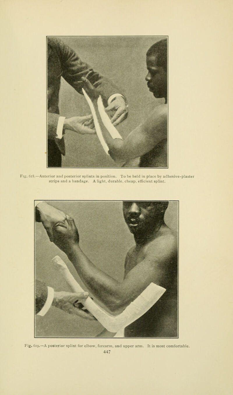 Fig. 6i8.—Anterior and posterior splints in position. To be held in place by adhesive-plaster strips and a bandage. A light, durable, cheap, efficient splint. Fig. 619.—A posterior splint for elbow, forearm, and upper arm. It is most comfortable.