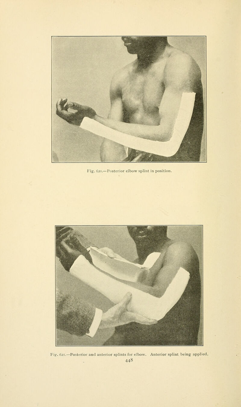 Fig. 620.— Posterior elbow splint in position. Fig. 621.—Posterior and anterior splints for elbow. Anterior splint being applied.