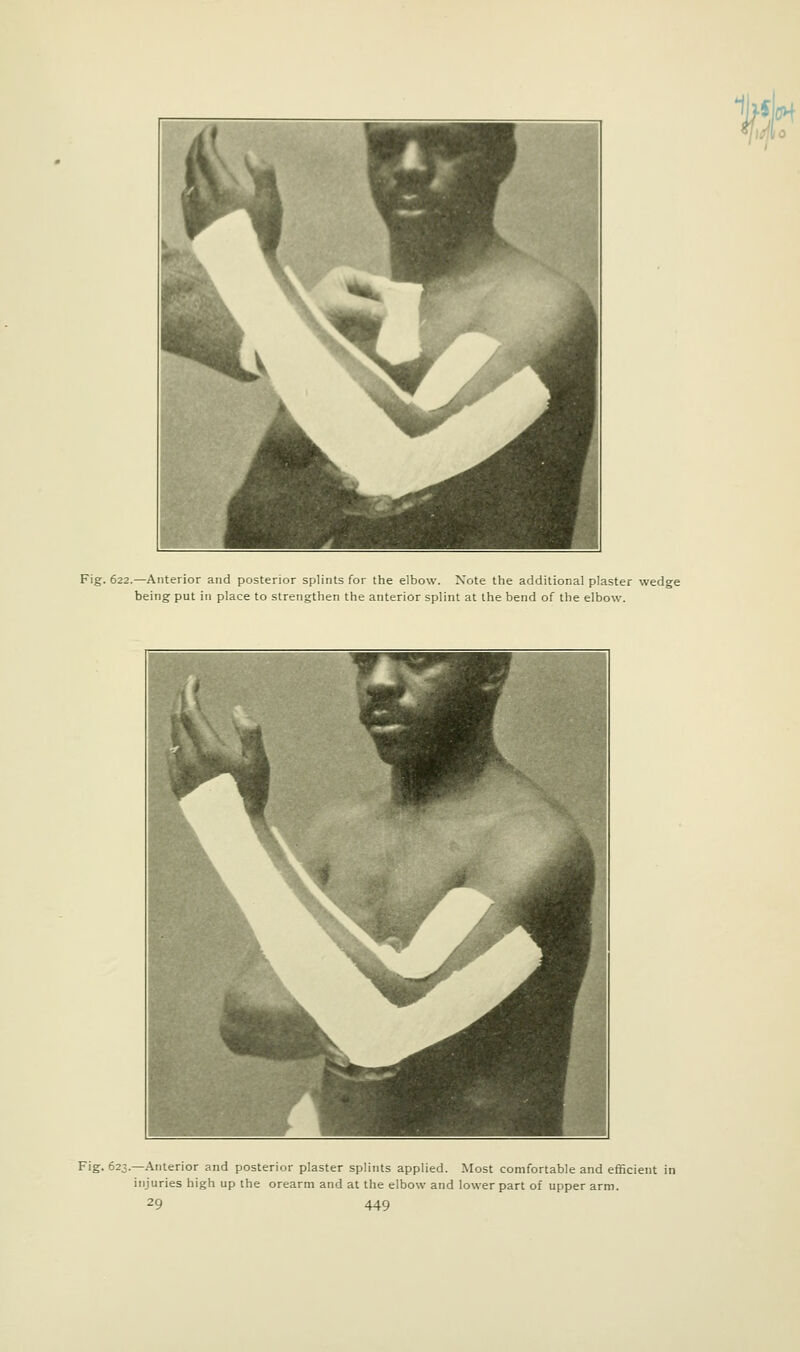 w Fig. 622.—Anterior and posterior splints for the elbow. Note the additional plaster wedge being put in place to strengthen the anterior splint at the bend of the elbow. Fig. 623.—Anterior and posterior plaster splints applied. Most comfortable and efficient in injuries high up the orearm and at the elbow and lower part of upper arm.