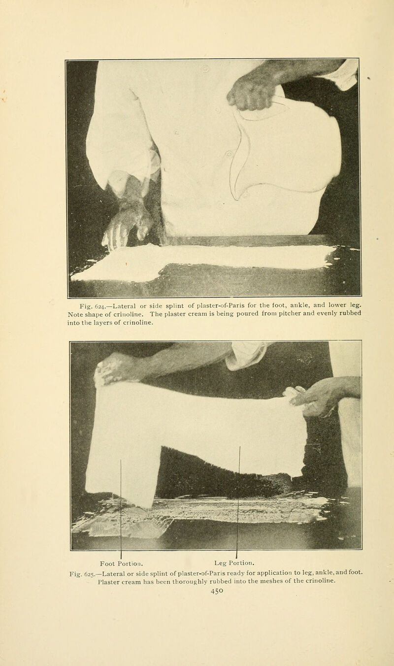 Fig. 624.—Lateral or side splint of plaster-of-Paris for the foot, ankle, and lower leg. Note shape of crinoline. The plaster cream is being poured from pitcher and evenly rubbed into the layers of crinoline. Foot Portion. Leg Portion. Fig. 625.—Lateral or side splint of plaster-of-Paris ready for application to leg, ankle, and foot. Plaster cream has been thoroughly rubbed into the meshes of the crinoline.