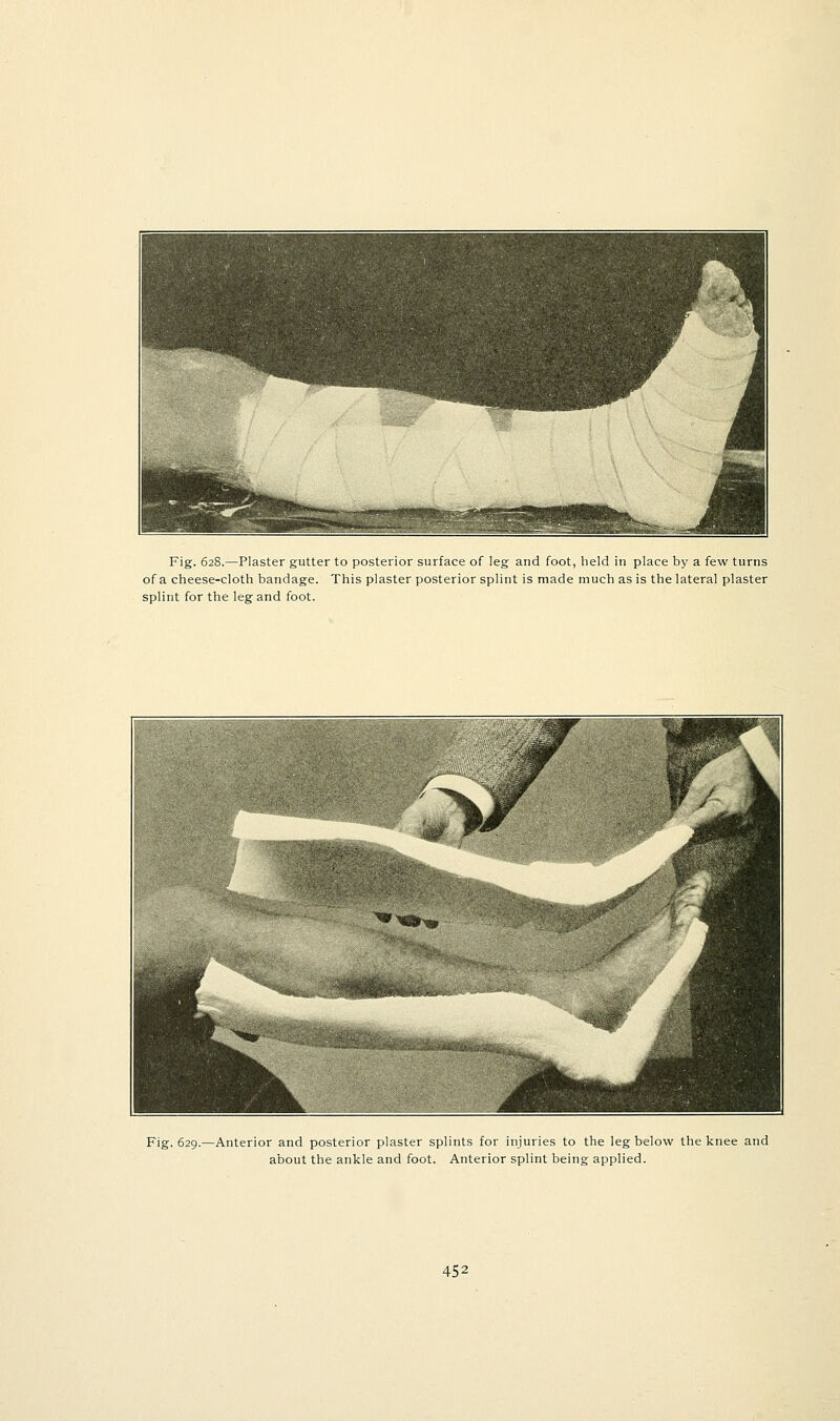 Fig. 628.—Plaster gutter to posterior surface of leg and foot, held in place by a few turns of a cheese-cloth bandage. This plaster posterior splint is made much as is the lateral plaster splint for the leg and foot. Fig. 629.- -Anterior and posterior plaster splints for injuries to the leg below the knee and about the ankle and foot. Anterior splint being applied.
