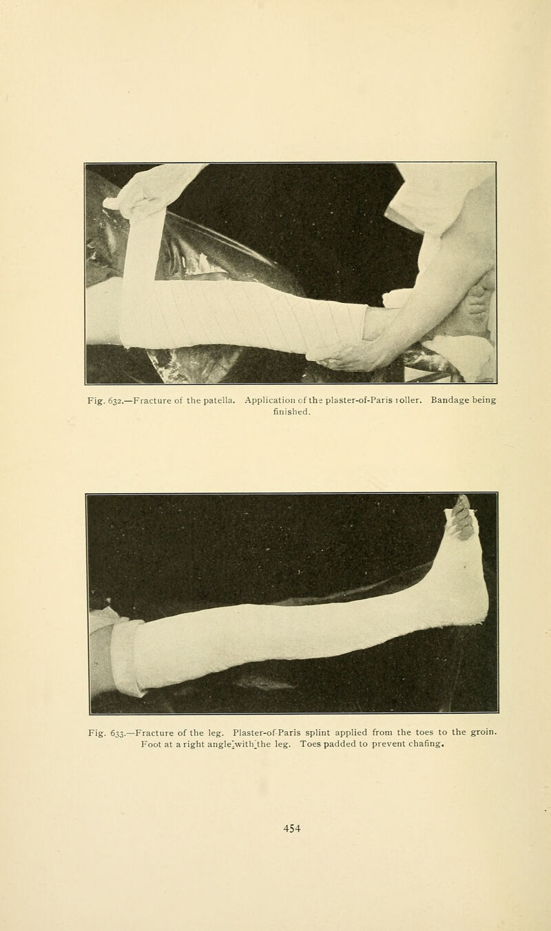 Fig. 632.—Fracture of the patella. Application of the plaster-of-Paris 1 oiler. finished. Bandage being Fig. 633.—Fracture of the leg. Plaster-ofParis splint applied from the toes to the Foot at aright angle]withjhe leg. Toes padded to prevent chafing.