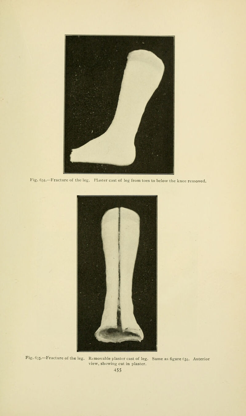 Fig. 634.—Fracture of the leg. Plaster cast of leg from toes to below the knee removed. Fig- 635.—Fracture of the leg. Removable plaster cast of leg. Same as figure 6J4. Anterior view, showing cut in plaster.