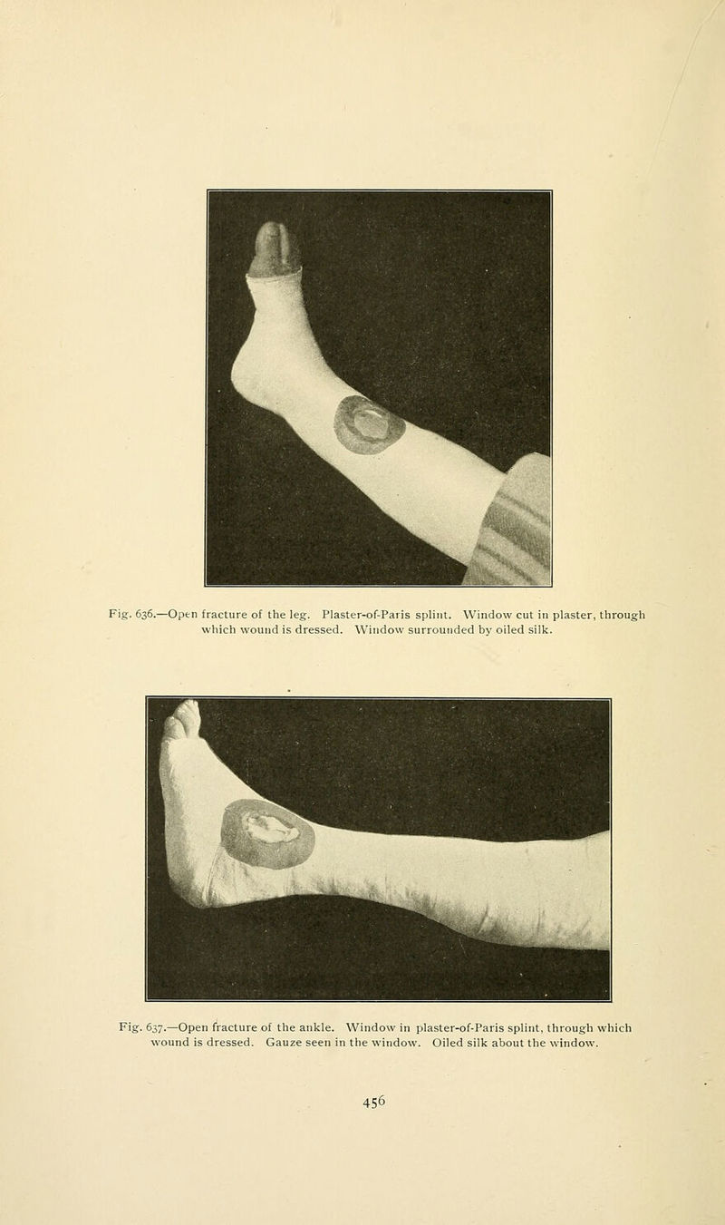 Fig. 636.—Open fracture of the leg. Plaster-of-Paris splint. Window cut in plaster, through which wound is dressed. Window surrounded by oiled silk. Fig. 637.—Open fracture of the ankle. Window in plaster-of-Paris splint, through which wound is dressed. Gauze seen in the window. Oiled silk about the window.