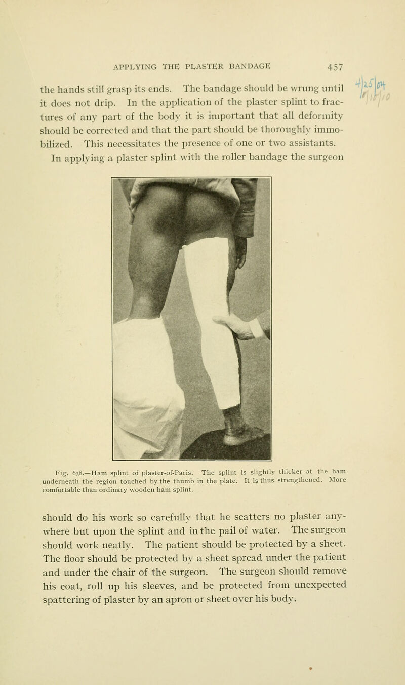 the hands still grasp its ends. The bandage should be wrung until it does not drip. In the application of the plaster splint to frac- tures of any part of the body it is ini]ic)rtant that all deformity should be corrected and that the part should be thoroughly immo- bilized. This necessitates the presence of one or two assistants. In applying a plaster splint with the roller bandage the surgeon Fig. 638.—Ham splint of plaster-of-Paris. The splint is slightly thicker at the ham underneath the region touched by the thumb in the plate. It is thus strengthened. More comfortable than ordinary wooden ham splint. should do his work so carefully that he scatters no plaster any- where but upon the splint and in the pail of water. The surgeon should work neatly. The patient should be protected by a sheet. The floor should be protected by a sheet spread under the patient and under the chair of the smgeon. The surgeon should remove his coat, roll up his sleeves, and be protected from unexpected spattering of plaster by an apron or sheet over his body.