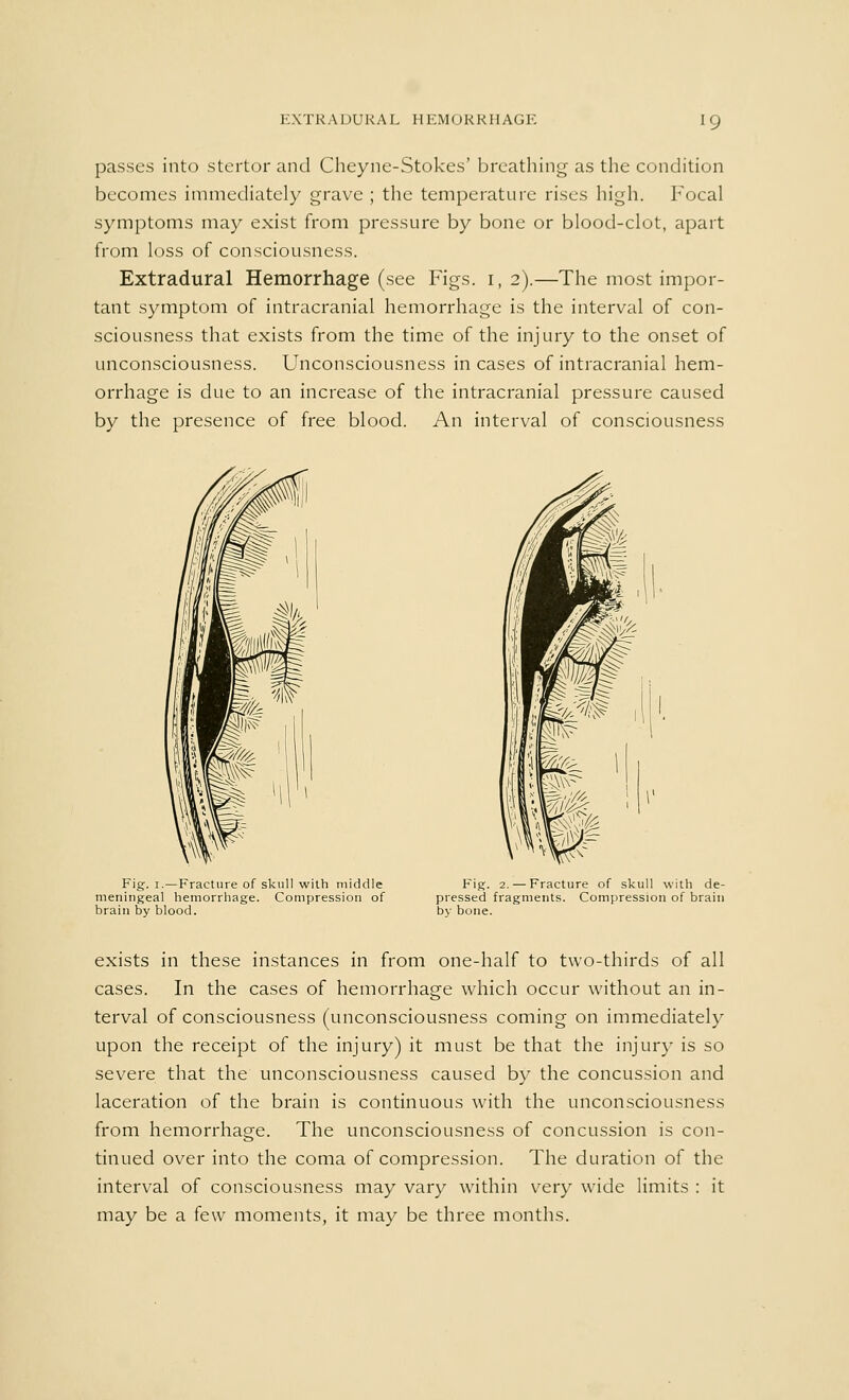 passes into stertor and Cheyne-Stokes' breathing as the condition becomes immediately grave ; the temperature rises high. Focal symptoms may exist from pressure by bone or blood-clot, apart from loss of consciousness. Extradural Hemorrhage (see Figs. 1,2).—The most impor- tant symptom of intracranial hemorrhage is the interval of con- sciousness that exists from the time of the injury to the onset of unconsciousness. Unconsciousness incases of intracranial hem- orrhage is clue to an increase of the intracranial pressure caused by the presence of free blood. An interval of consciousness Fig. 1.—Fracture of skull with middle meningeal hemorrhage. Compression of brain by blood. Fig. 2. — Fracture of skull with de- pressed fragments. Compression of brain by bone. exists in these instances in from one-half to two-thirds of all cases. In the cases of hemorrhage which occur without an in- terval of consciousness (unconsciousness coming on immediately upon the receipt of the injury) it must be that the injury is so severe that the unconsciousness caused by the concussion and laceration of the brain is continuous with the unconsciousness from hemorrhage. The unconsciousness of concussion is con- tinued over into the coma of compression. The duration of the interval of consciousness may vary within very wide limits : it may be a few moments, it may be three months.