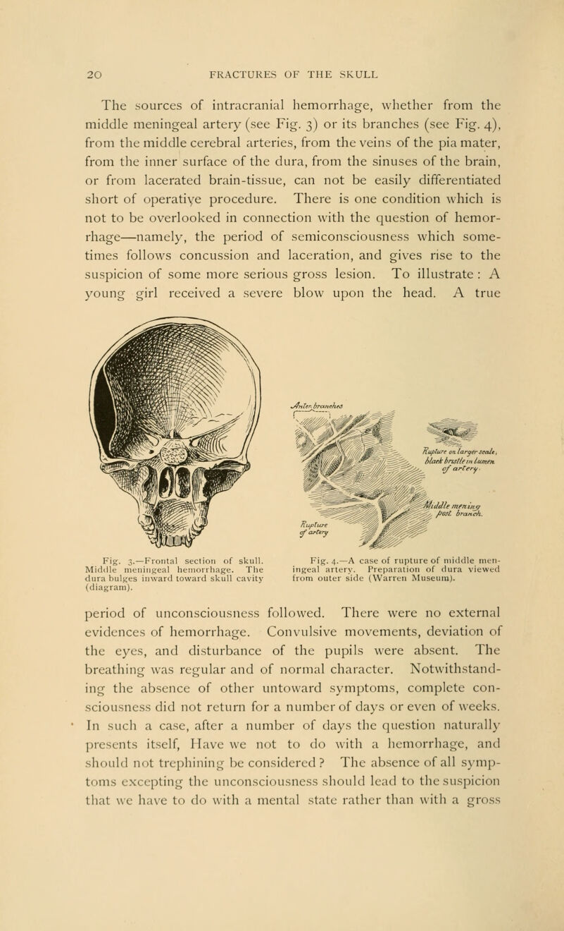 The sources of intracranial hemorrhage, whether from the middle meningeal artery (see Fig. 3) or its branches (see Fig. 4), from the middle cerebral arteries, from the veins of the pia mater, from the inner surface of the dura, from the sinuses of the brain, or from lacerated brain-tissue, can not be easily differentiated short of operatiye procedure. There is one condition which is not to be overlooked in connection with the question of hemor- rhage—namely, the period of semiconsciousness which some- times follows concussion and laceration, and gives rise to the suspicion of some more serious gross lesion. To illustrate : A young girl received a severe blow upon the head. A true Fig. 3. — Frontal section of skull. Middle meningeal hemorrhage. The dura bulges inward toward skull cavity (diagram). ~4nUr. brctnehe. ^Q Rupture of artery Fig. 4.—A case of rupture of middle men- ingeal artery. Preparation of dura viewed from outer side (Warren Museum). Euplure on larger scale, black bristle in lumen , of artero ■ Middle meninjr gf, fiost branch. period of unconsciousness followed. There were no external evidences of hemorrhage. Convulsive movements, deviation of the eyes, and disturbance of the pupils were absent. The breathing was regular and of normal character. Notwithstand- ing the absence of other untoward symptoms, complete con- sciousness did not return for a number of days or even of weeks. In such a case, after a number of days the question naturally presents itself, Have we not to do with a hemorrhage, and should not trephining be considered? The absence of all symp- toms excepting the unconsciousness should lead to the suspicion that we have to do with a mental state rather than with a gross