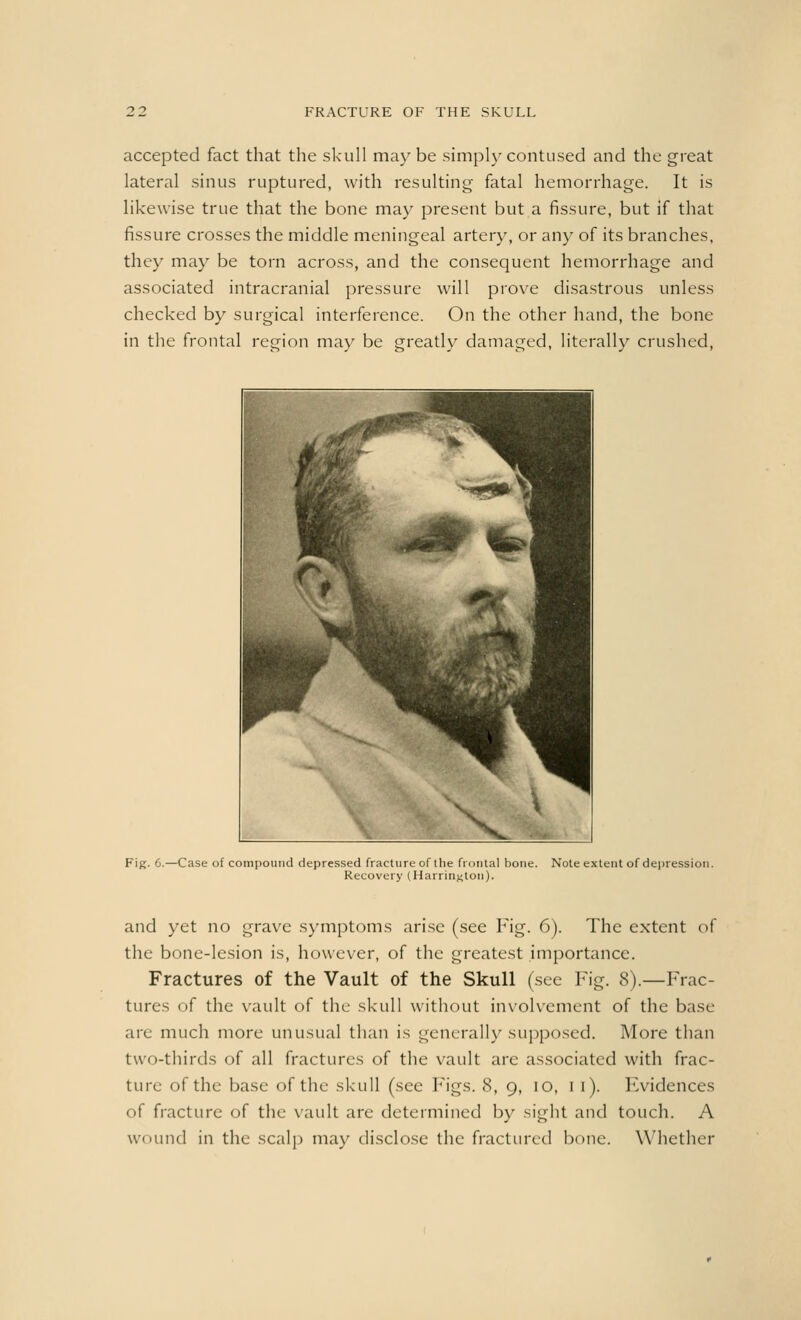 accepted fact that the skull may be simply contused and the great lateral sinus ruptured, with resulting fatal hemorrhage. It is likewise true that the bone may present but a fissure, but if that fissure crosses the middle meningeal artery, or any of its branches, they may be torn across, and the consequent hemorrhage and associated intracranial pressure will prove disastrous unless checked by surgical interference. On the other hand, the bone in the frontal region may be greatly damaged, literally crushed, Fig. 6.—Case of compound depressed fracture of the frontal bone. Note extent of depression. Recovery (Harrington). and yet no grave symptoms arise (see Fig. 6). The extent of the bone-lesion is, however, of the greatest importance. Fractures of the Vault of the Skull (see Fig. 8).—Frac- tures of the vault of the skull without involvement of the bast- arc much more unusual than is generally supposed. More than two-thirds of all fractures of the vault are associated with frac- ture of the base of the skull (see Figs. 8, 9, 10, 1 1). Evidences of fracture of the vault are determined by sight and touch. A wound in the scalp may disclose the fractured bone. Whether