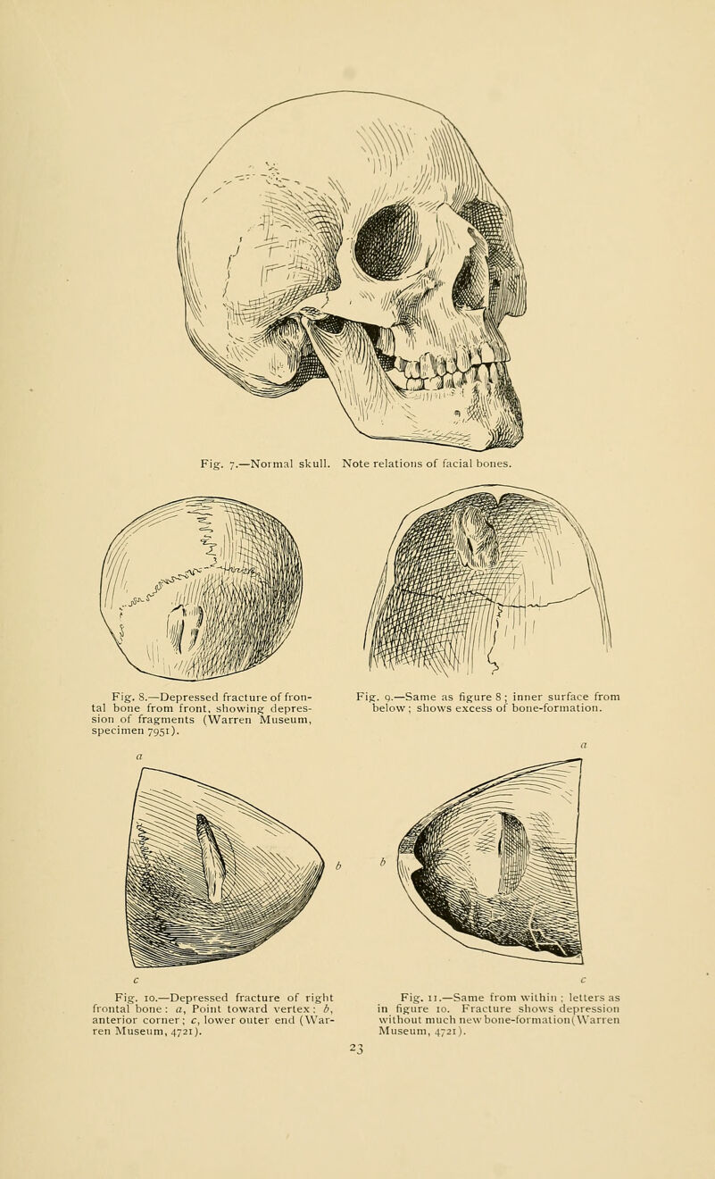 Fig. 8.—Depressed fracture of fron- tal bone from front, showing depres- sion of fragments (Warren Museum, specimen 7951). Fig. 9.—Same as figure 8 ; inner surface from below ; shows excess of bone-formation. Fig. 10.—Depressed fracture of right frontal bone: a, Point toward vertex: b, anterior corner; c, lower outer end (War- ren Museum, 4721). Fig. 11.—Same from within ; letters as in figure 10. Fracture shows depression without much newbone-formalion(Warren Museum, 4721).