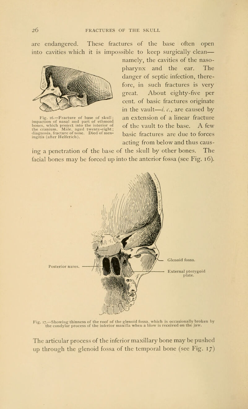 are endangered. These fractures of the base often open into cavities which it is impossible to keep surgically clean— namely, the cavities of the naso- pharynx and the ear. The danger of septic infection, there- fore, in such fractures is very great. About eighty-five per cent, of basic fractures originate in the vault—i. c, are caused by an extension of a linear fracture of the vault to the base. A few basic fractures are due to forces acting from below and thus caus- ing a penetration of the base of the skull by other bones. The facial bones may be forced up into the anterior fossa (see Fig. 16). Fig. 16.—Fracture of base of skull ; impaction of nasal and part of ethmoid bones, which project into the interior of the cranium. Male, aged twenty-eight; diagnosis, fracture of nose. Died of men- ingitis (after Helferich). Posterior nares. Glenoid fossa. External pterygoid plate. Fig. 17.—Showing thinness of the roof of the glenoid fossa, which is occasionally broken by the condylar process of the inferior maxilla when a blow is received on the jaw. The articular process of the inferior maxillary bone may be pushed up through the glenoid fossa of the temporal bone (see Fig. 17)