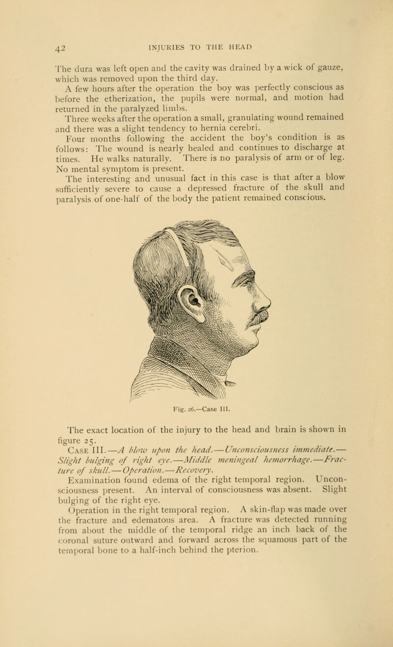 The dura was left open and the cavity was drained by a wick of gauze, which was removed upon the third day. A few hours after the operation the boy was perfectly conscious as before the etherization, the pupils were normal, and motion had returned in the paralyzed limbs. Three weeks after the operation a small, granulating wound remained and there was a slight tendency to hernia cerebri. Four months following the accident the boy's condition is as follows: The wound is nearly healed and continues to discharge at times. He walks naturally. There is no paralysis of arm or of leg. No mental symptom is present. The interesting and unusual fact in this case is that after a blow sufficiently severe to cause a depressed fracture of the skull and paralysis of one-half of the body the patient remained conscious. Fig. 26.—Case III. The exact location of the injury to the head and brain is shown in figure 25. Case III.—A blow upon the head.—Uncoiisciousness immediate.— Slight bulging of right eye.—Middle meningeal hemorrhage.—Frac- ture of skull. — Operation.—Recovery. Examination found edema of the right temporal region. Uncon- sciousness present. An interval of consciousness was absent. Slight bulging of the right eye. Operation in the right temporal region. A skin-flap was made over the fracture and edematous area. A fracture was detected running from about the middle of the temporal ridge an inch back of the coronal suture outward and forward across the squamous part of the temporal bone to a half-inch behind the pterion.