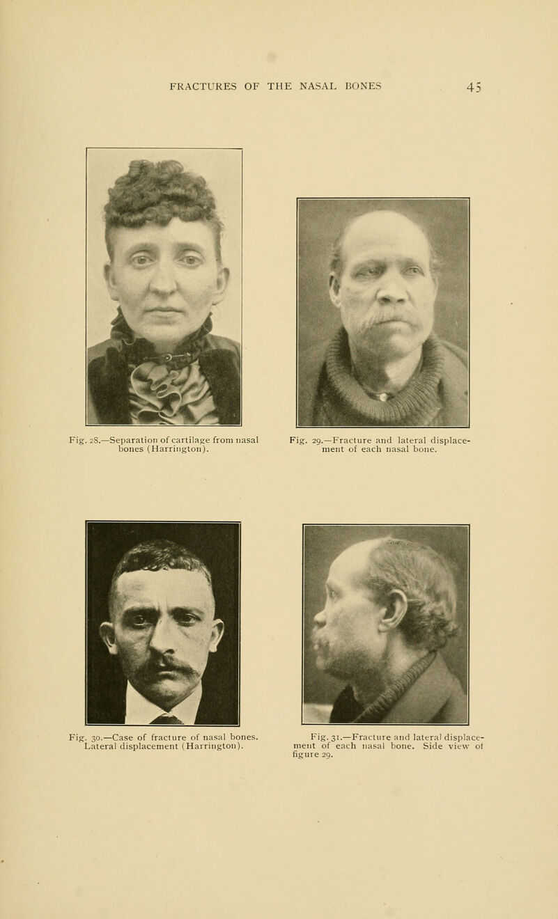 rr VB\ a 1 ^■^■W.- ■ftafc CN* ■^8 Fig. 28.—Separation of cartilage from nasal bones (Harrington). Fig. 29.—Fracture and lateral displace- ment of each nasal bone. Fig. 30.—Case of fracture of nasal bones. Lateral displacement (Harrington). Fig. 31.—Fracture and lateral displace- ment of each nasal bone. Side view ot figure 29.